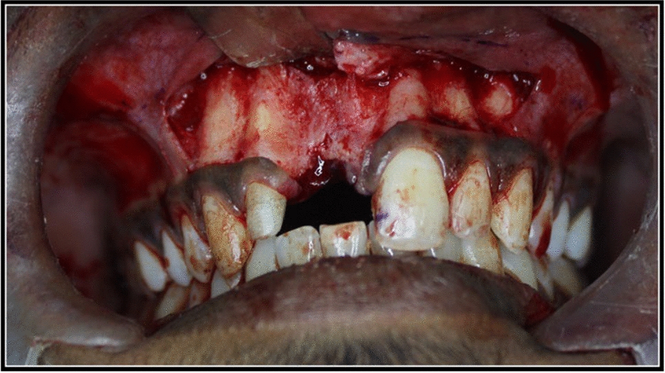 Clinical Implications of Mandibular Symphysis Block Graft for Dental Implants: A 10-year Long Term Prospective Observational Study
