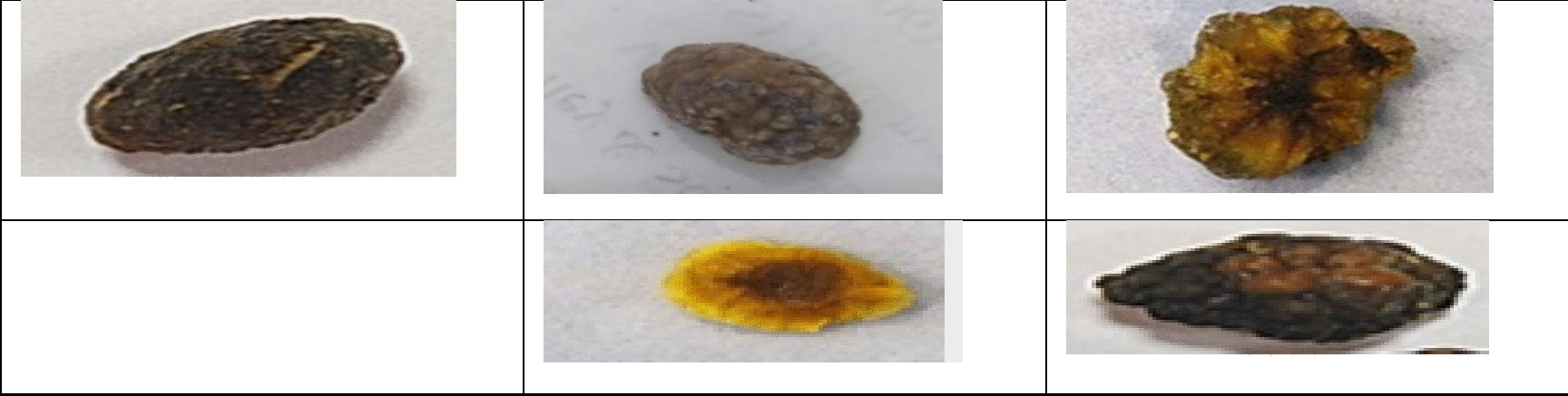 Hardness investigation of the kidney stones using laser induced breakdown spectroscopy (LIBS) technique