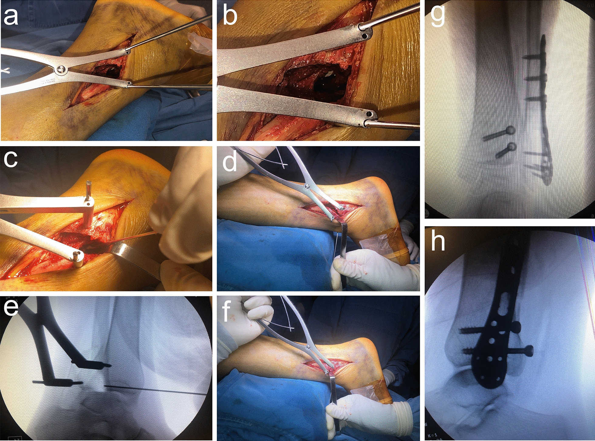 Reduction and outcome of posterior pilon fractures with intercalary fragments: a retrospective cohort study comparing the transfibular and posteromedial approaches