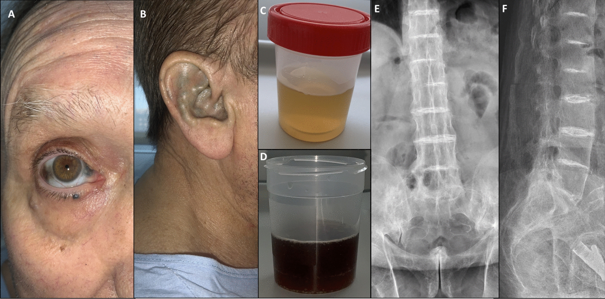 Alkaptonuria: a rare disorder associated with common conditions