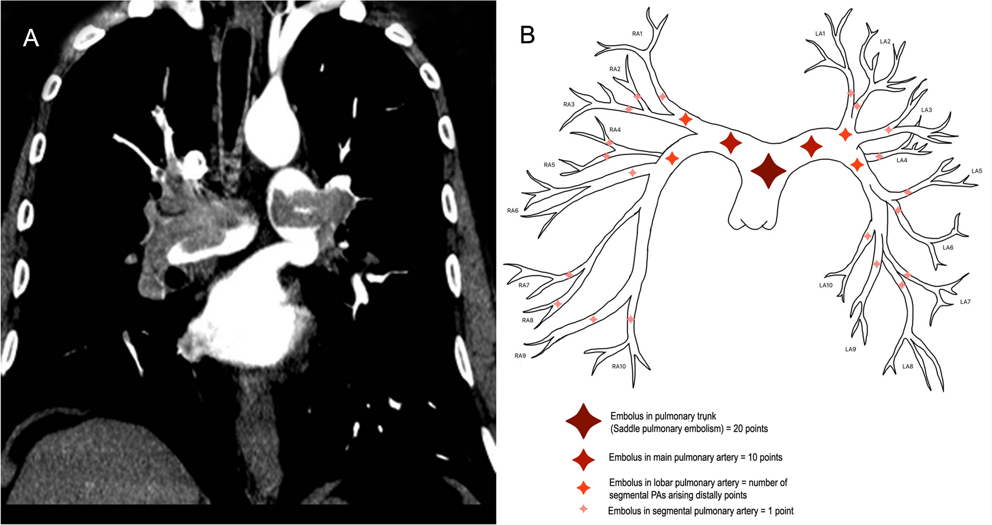 Saddle pulmonary embolism: results of a series of patients undergoing pharmaco-mechanical thrombolysis