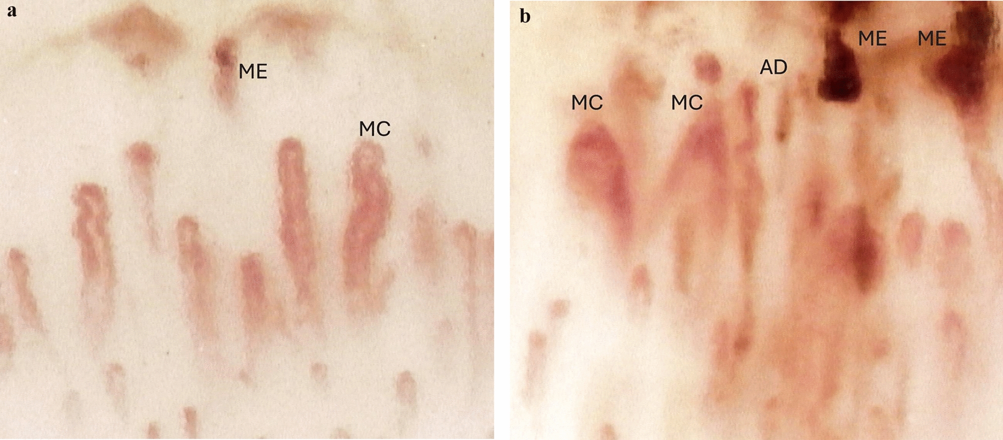 Lithium and smoking-associated scleroderma-like pattern in a 18-year-old patient: a case report