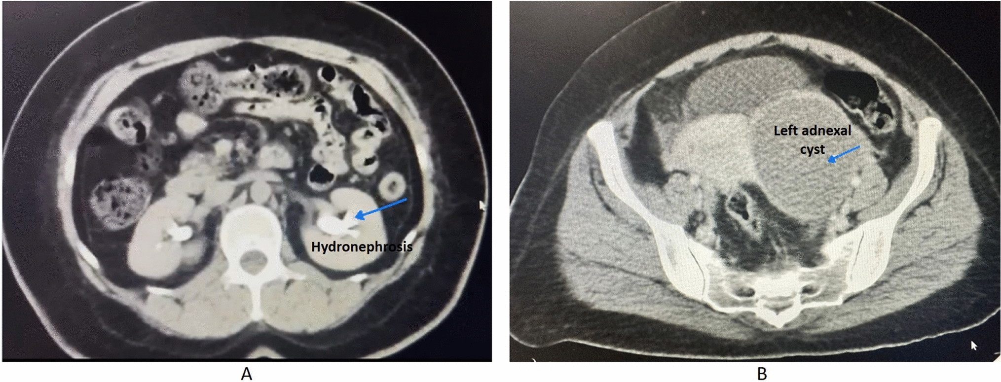 Obstructive Uropathy Secondary to Pelvic Endometriosis: A Scary Story!