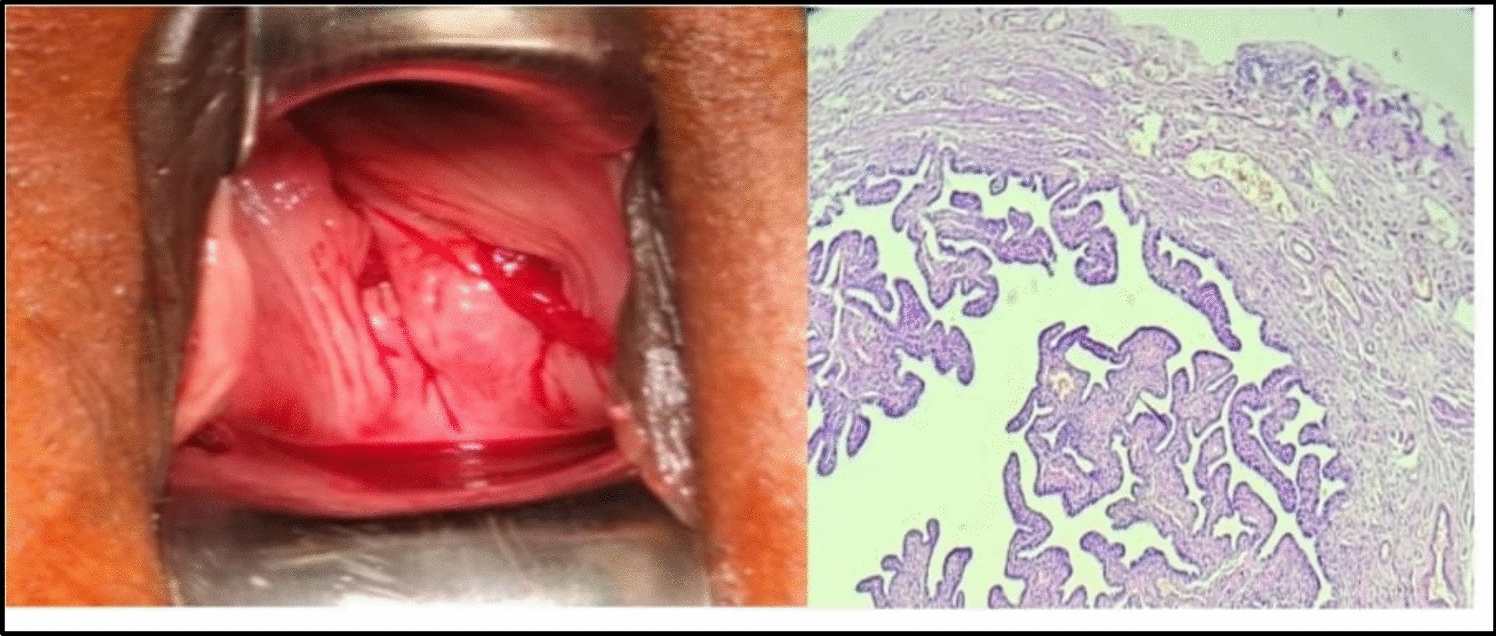 Post-op Puzzle: Deciphering Fallopian Tube Prolapse After Hysterectomy