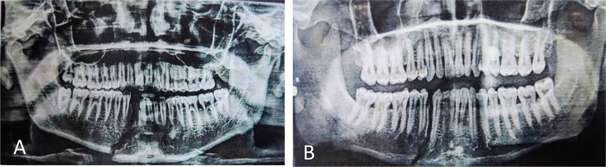 Comparative evaluation of lag screws and miniplates in the fixation of anterior mandibular fractures– a prospective study