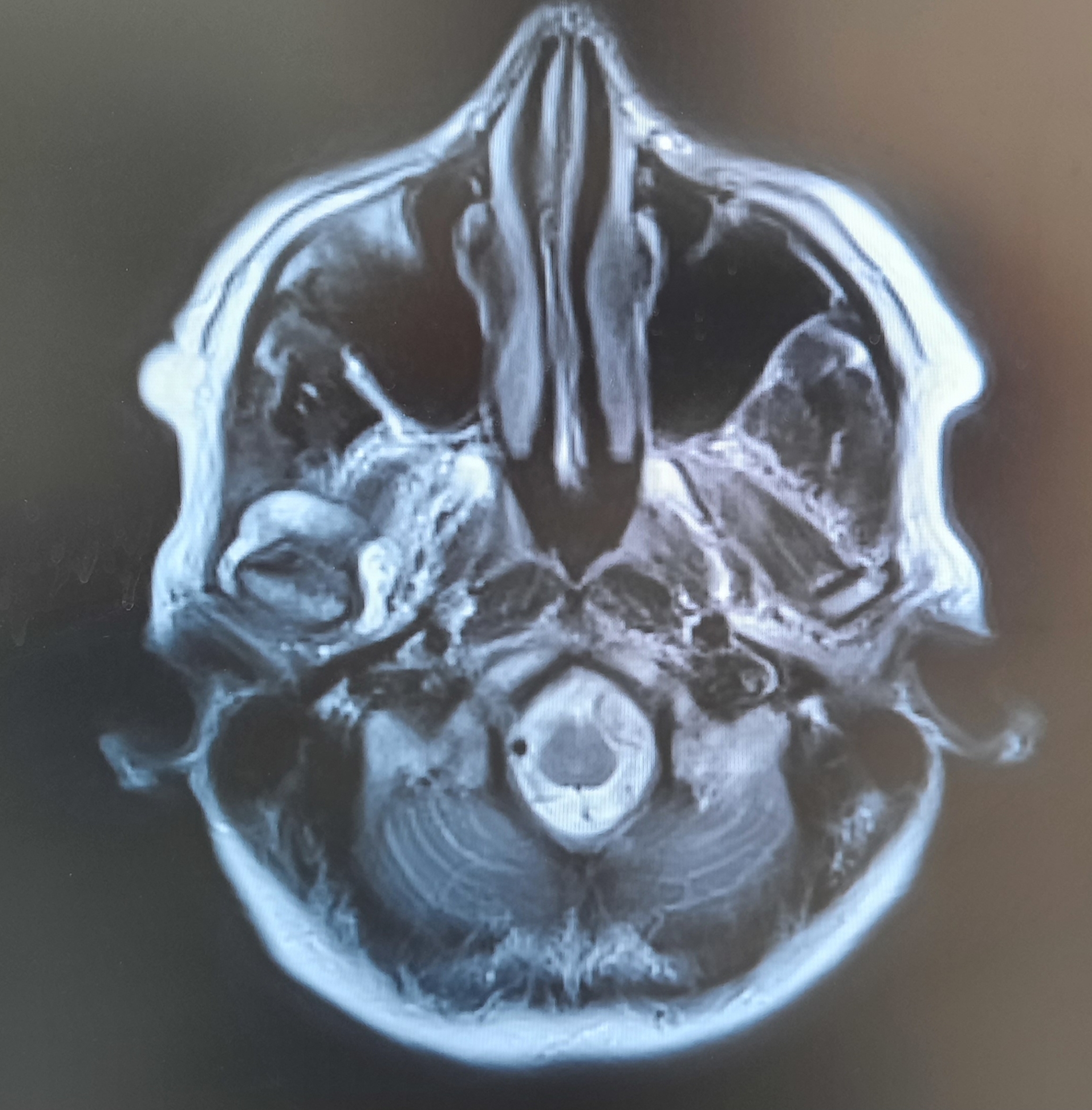 Pigmented villonodular synovitis of the temporomandibular joint. evaluation of 12 patients from 2017 to 2023