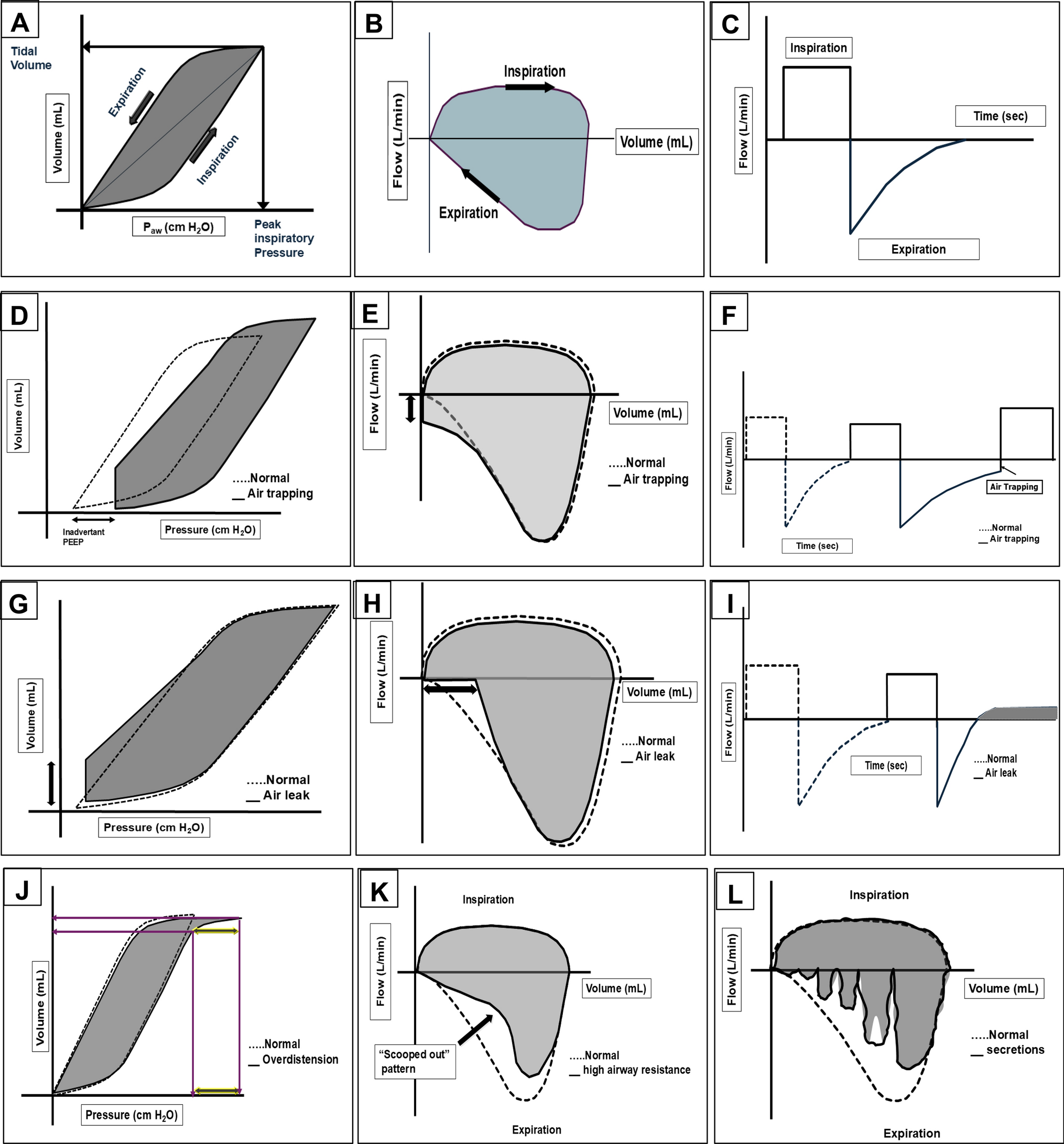 Invasive Ventilation Strategies in Neonates