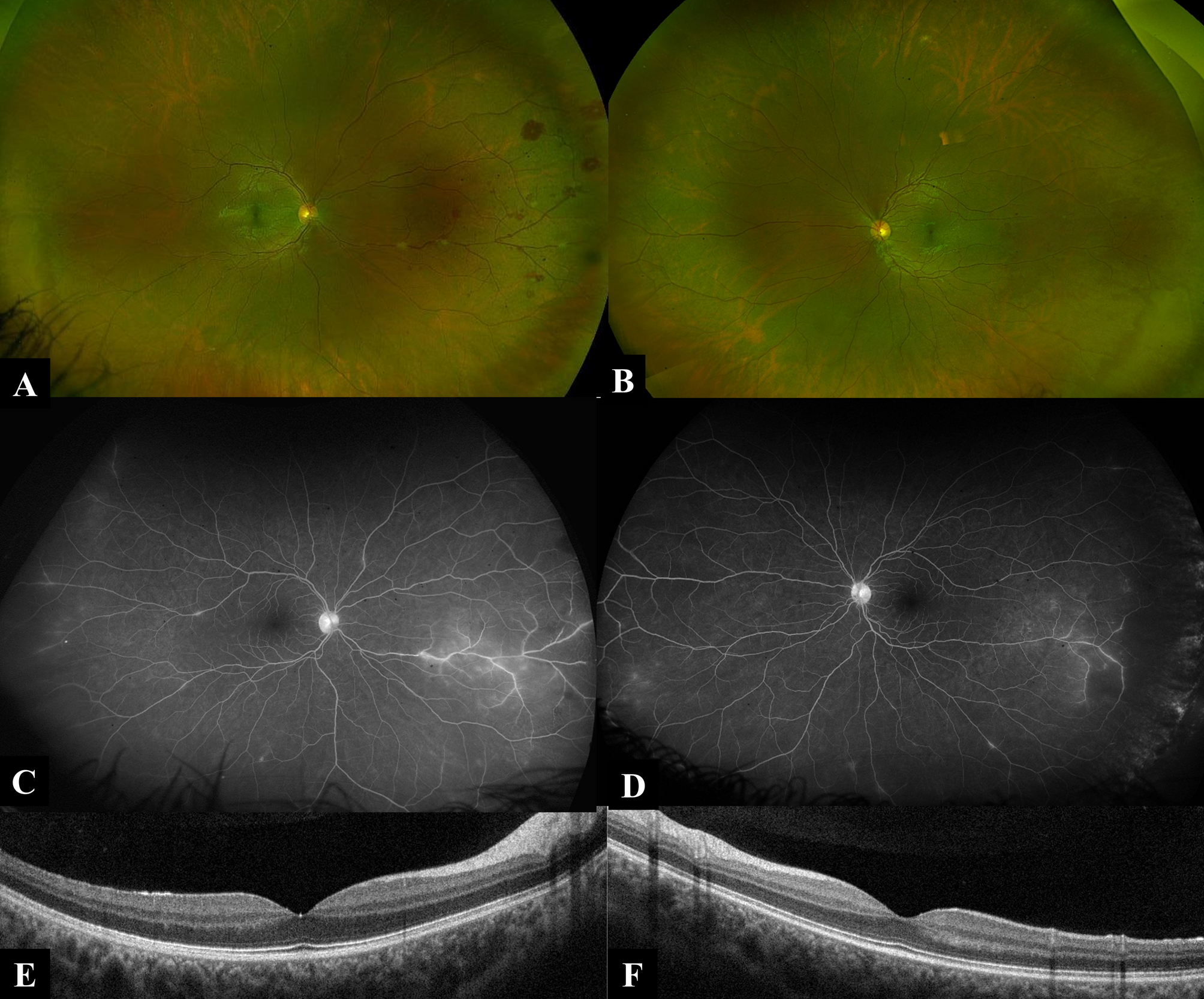 Concurrent uveitis in monozygotic twins in the context of systemic sarcoidosis