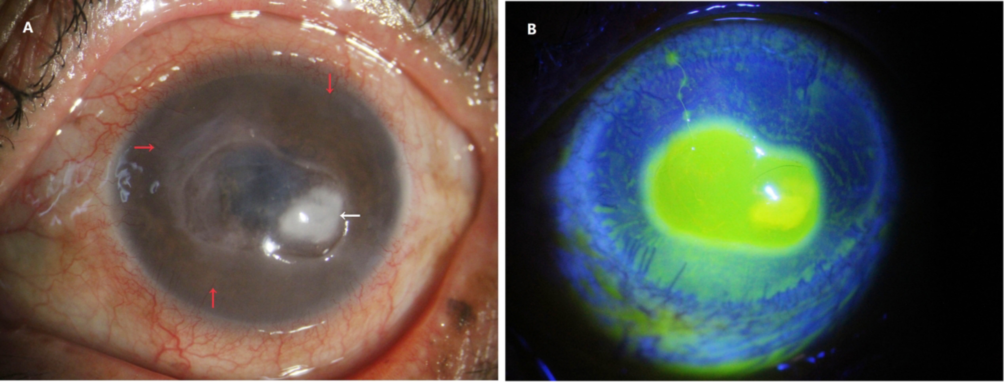 First report of Stemphylium lycopersici keratitis, a complex corneal infection case