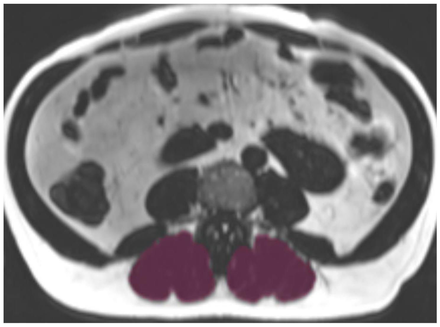 Paraspinal myosteatosis is associated with COPD: a cross-sectional MRI analysis from the population-based KORA cohort