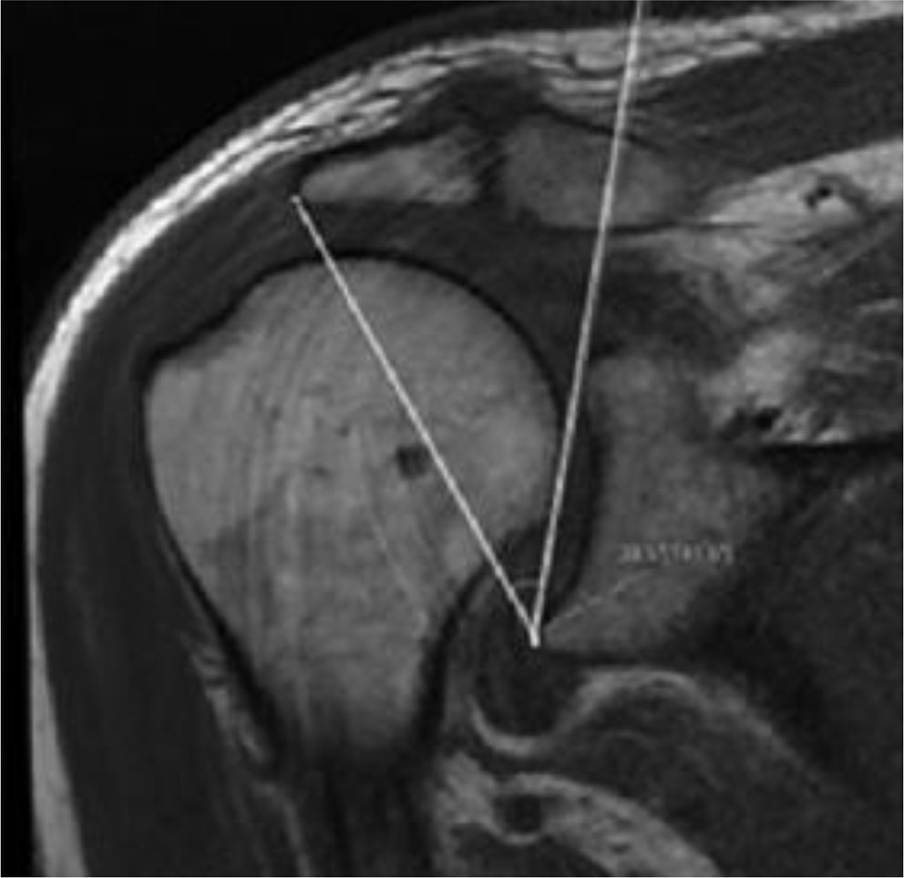 Characteristics of acromial morphology in patients with painful shoulders from Indonesia