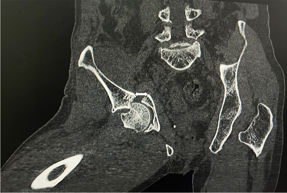 The Kocher-Langenbeck approach combined with TiRobot-assisted percutaneous anterior column screw fixation for transverse with or without posterior wall fractures of acetabulum: a retrospective study