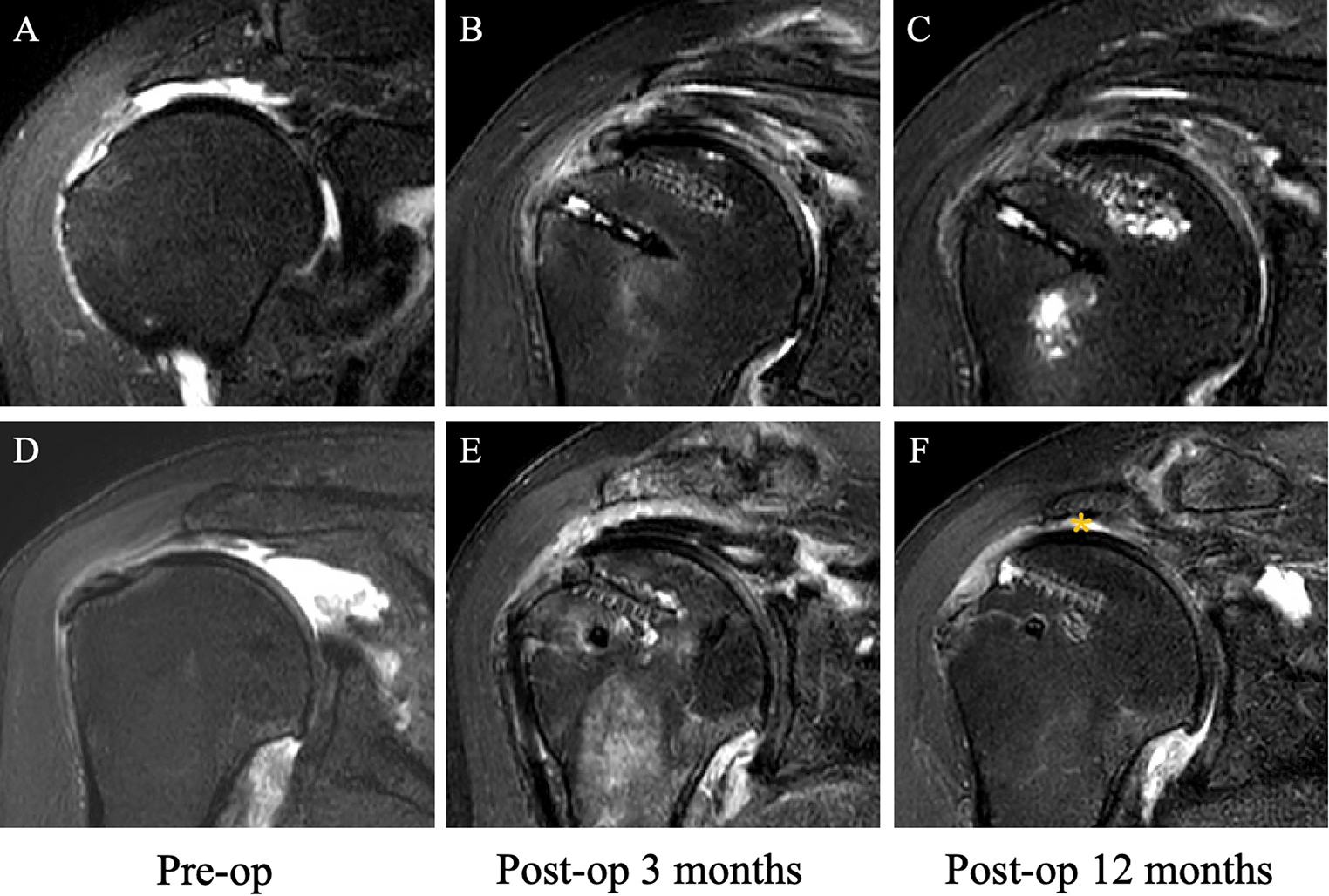 Superior capsular reconstruction after failed rotator cuff repair using a fascia lata autograft is associated with inferior outcomes compared to primary superior capsular reconstruction for irreparable massive rotator cuff tears