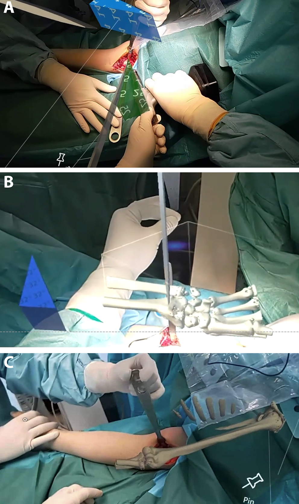 Mixed reality guidance in osteotomy provides superior precision and accuracy: validation and comparative study