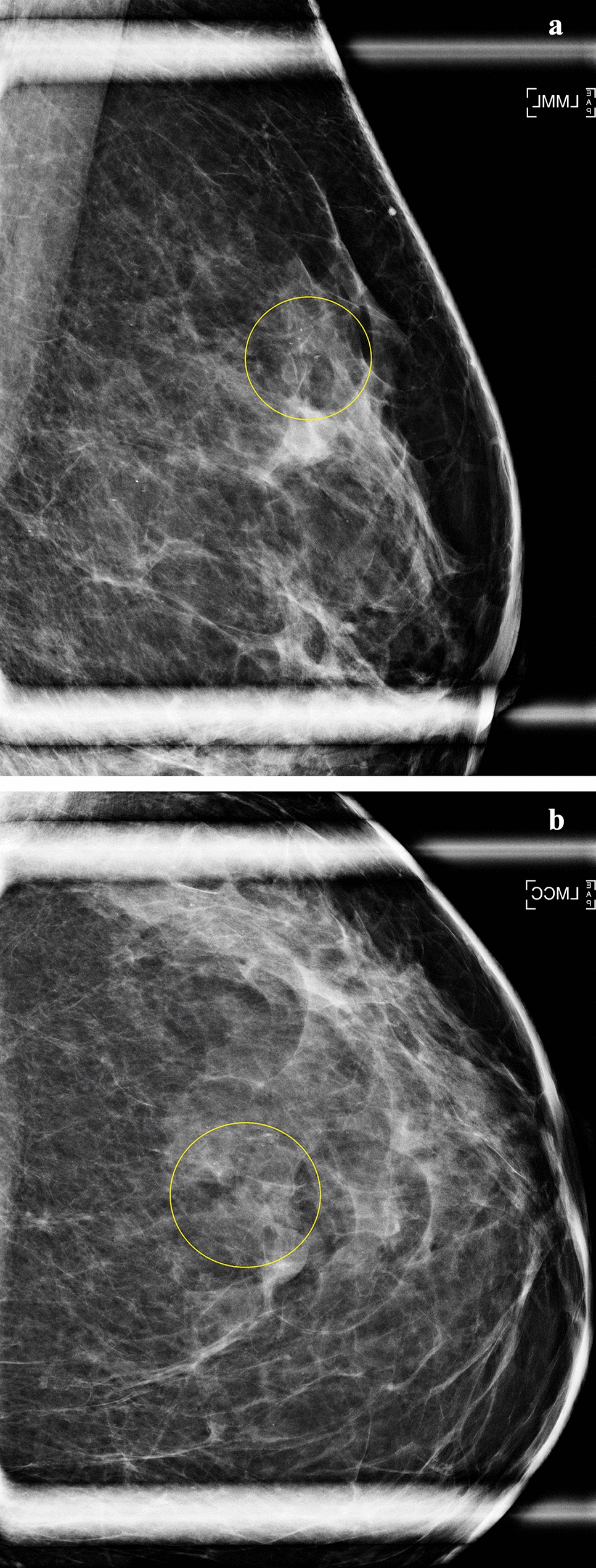 Mammographic calcifications association with risk of advanced breast cancer