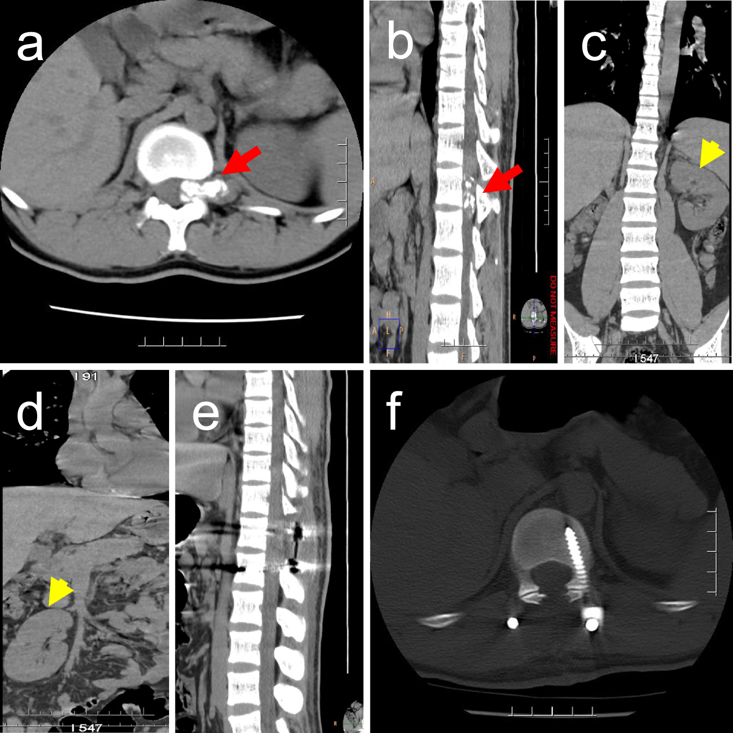 Intraspinal  rearranged tumor with nerve differentiation