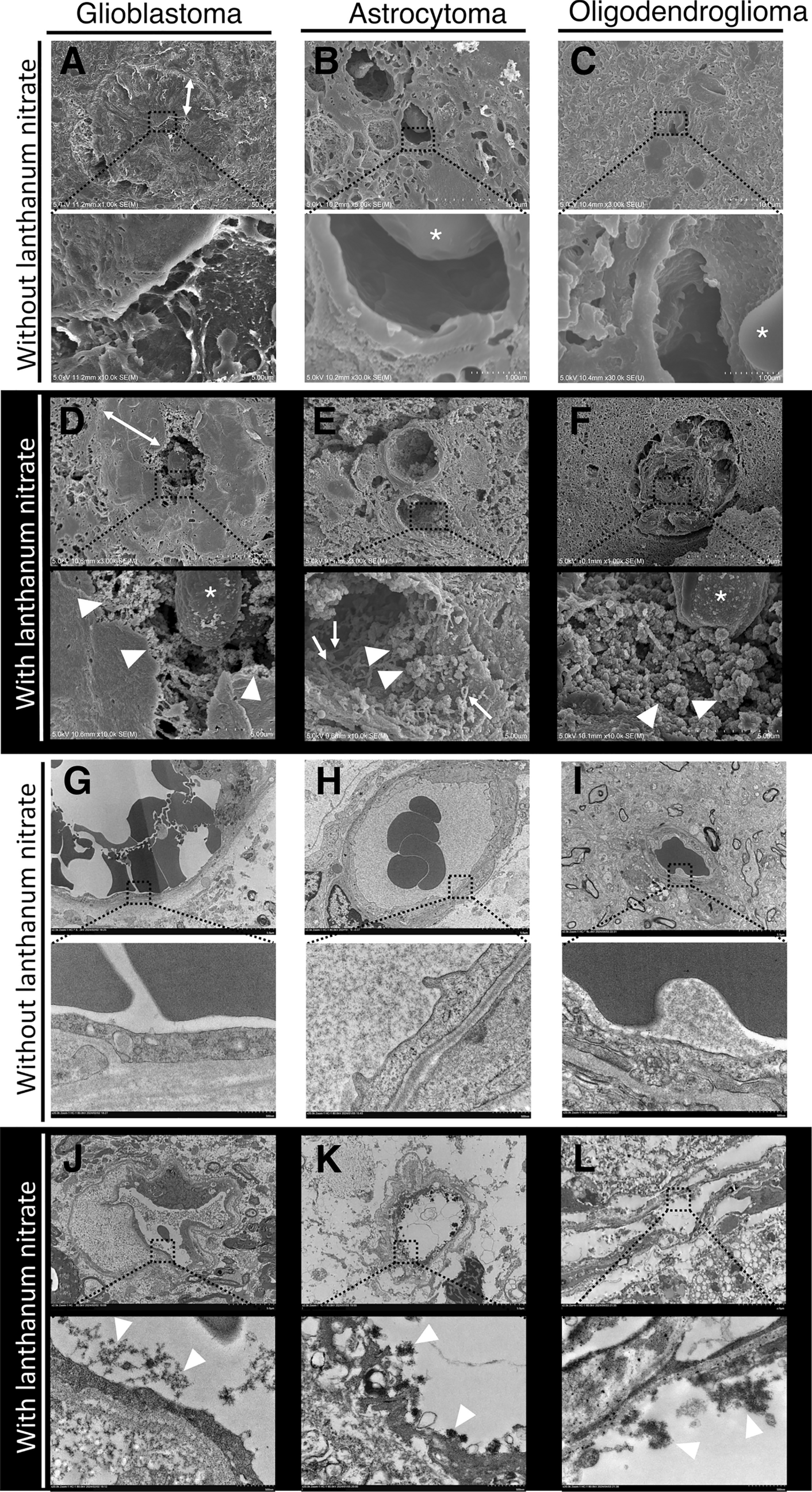 Visualizing the endothelial glycocalyx in human glioma vasculature