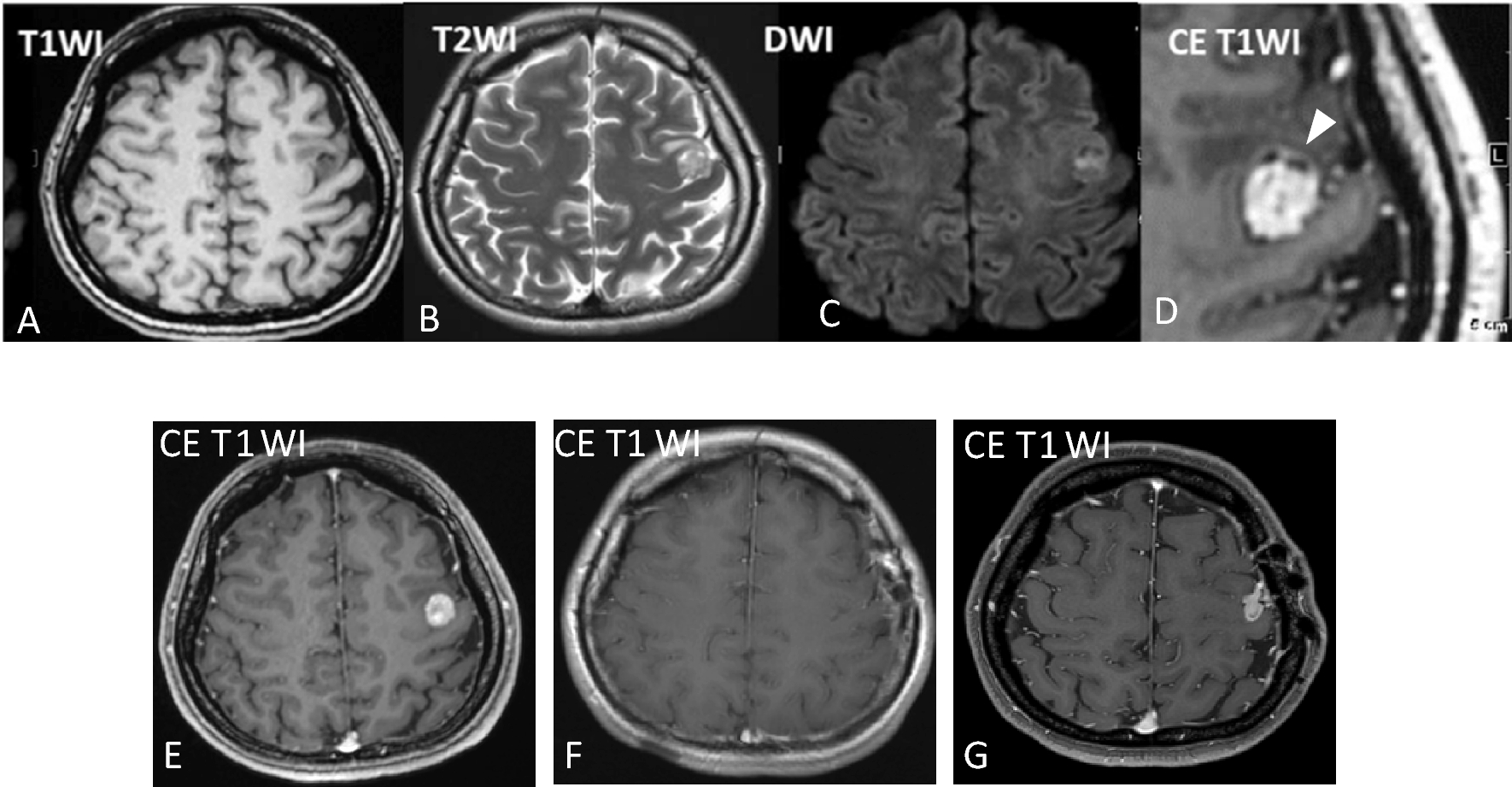 Novel case of ependymoma-like tumor with mesenchymal differentiation harboring  fusion in an adult