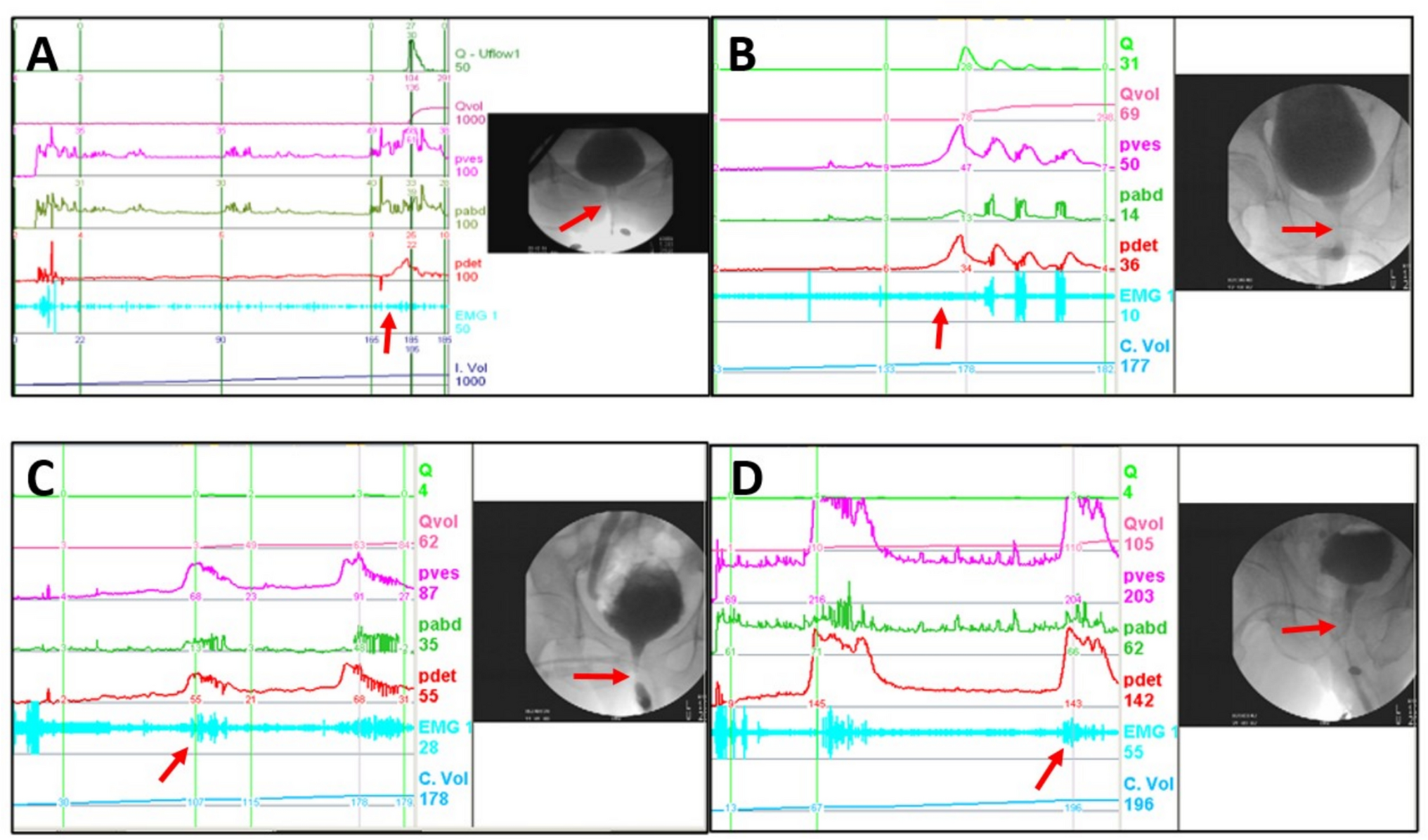Videourodynamic predictive factors of urological complications in patients with chronic spinal cord injury and detrusor sphincter dyssynergia