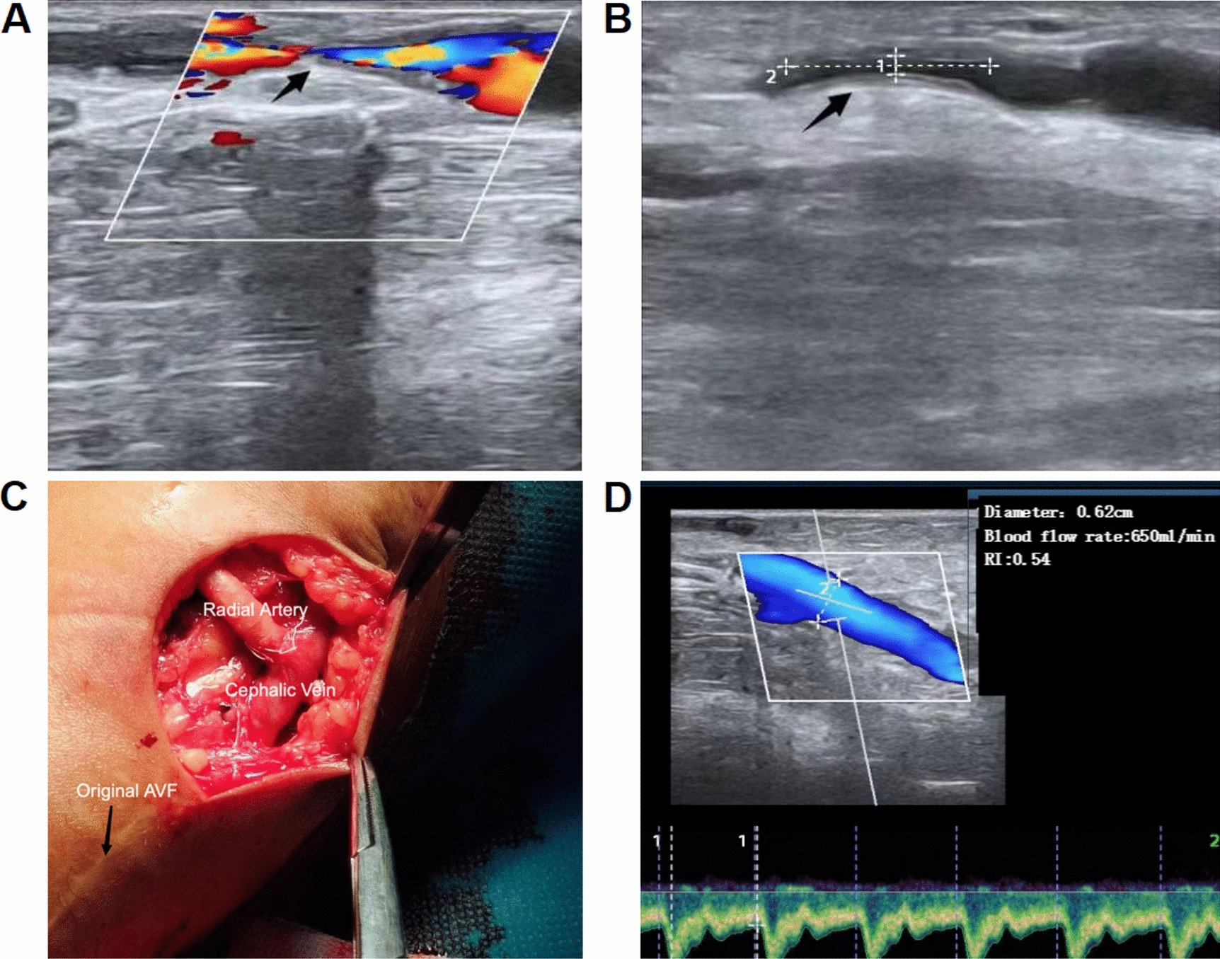 Comparison of the primary outcome of the radial artery deviation and reimplantation technique and the ultrasound-guided percutaneous transluminal angioplasty in the treatment of forearm arteriovenous fistula type I stenosis in haemodialysis patients: a pilot study