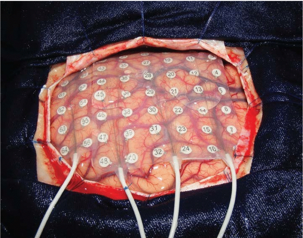 Super-resolution for localizing electrode grids as small, deformable objects during epilepsy surgery using augmented reality headsets