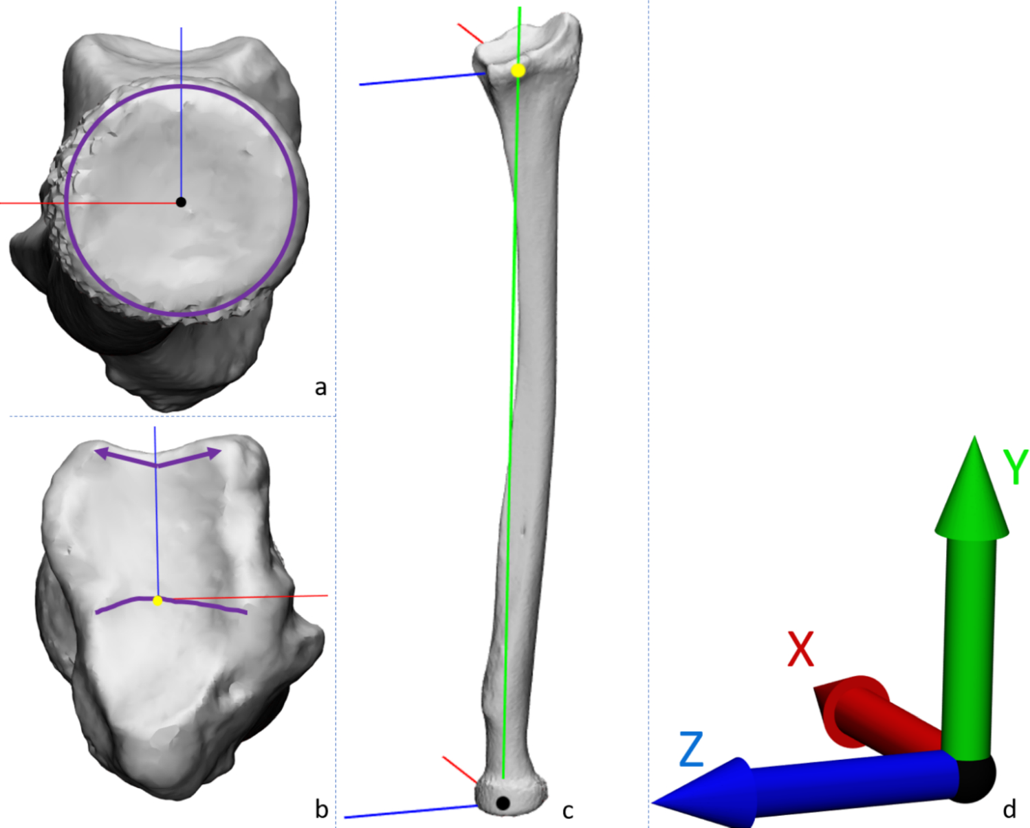A shape completion model for corrective osteotomy of distal radius malunion