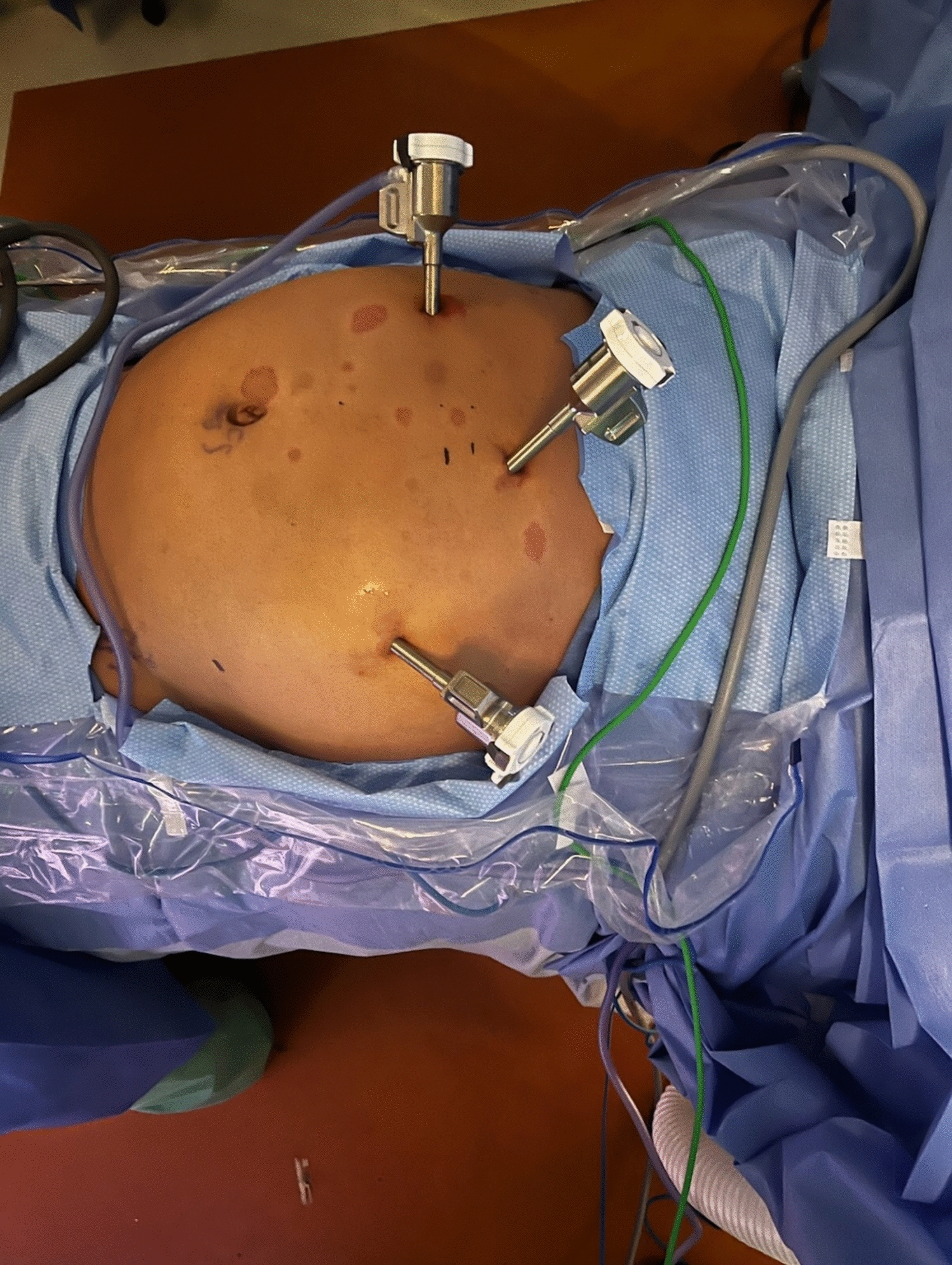 A Comprehensive Review of the Evolution of Minimally Invasive Hernia Repair: Historical Milestones to Modern Clinical Practice