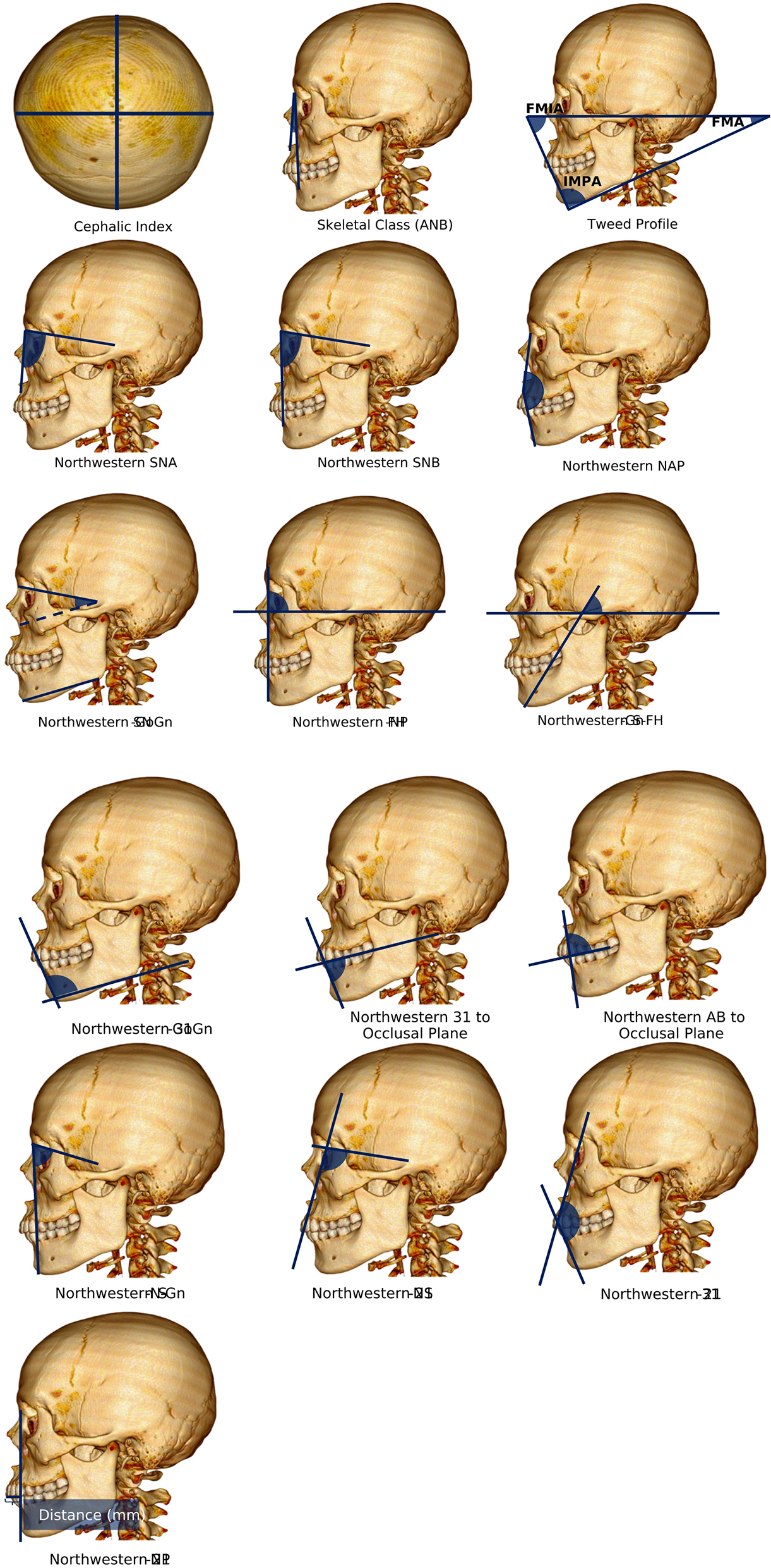 Assessing the contribution of orthodontic profiles in predicting facial soft tissue thickness for forensic facial approximation