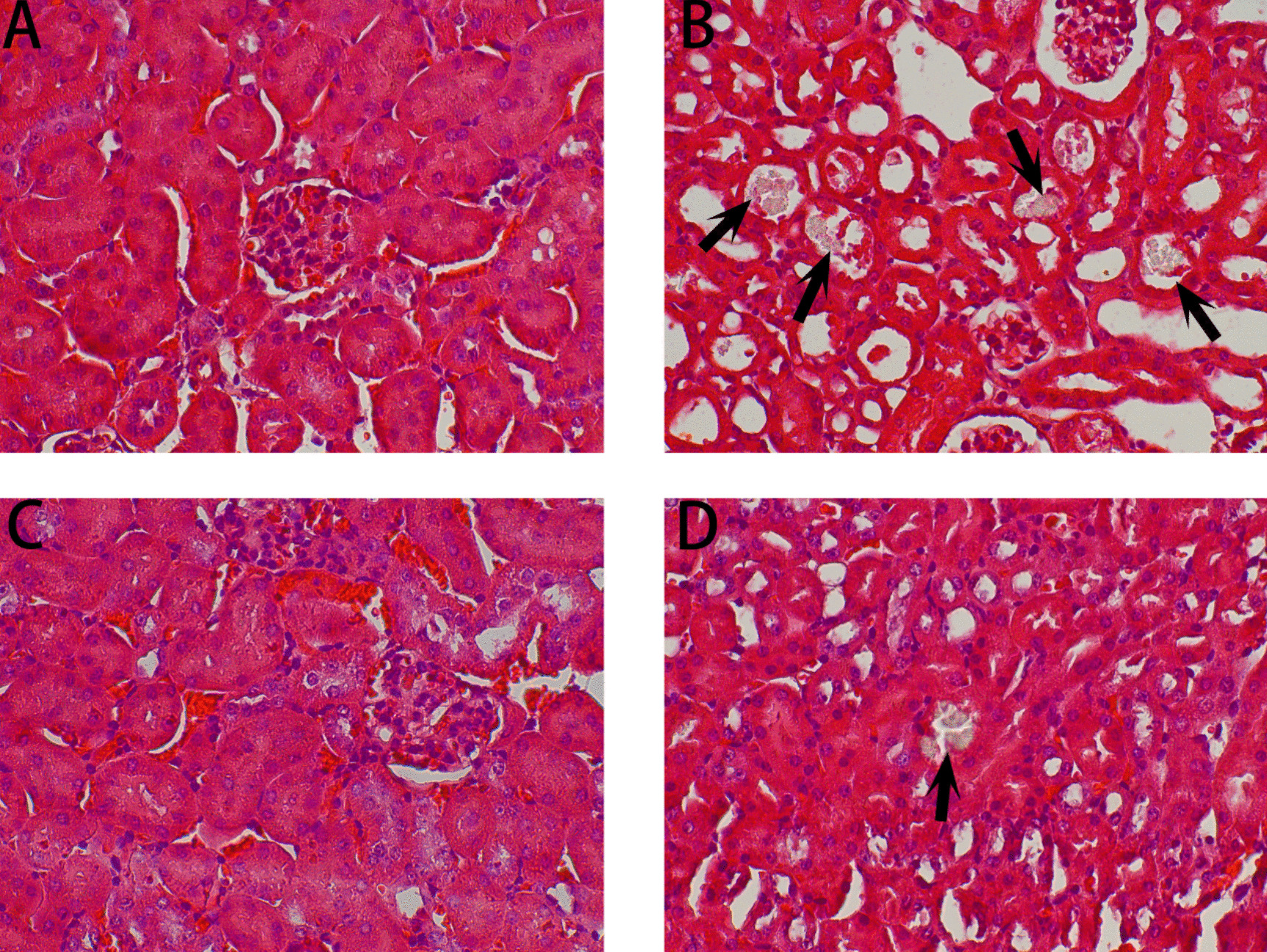 Efficacy Analysis of Potassium Sodium Hydrogen Citrate in Inhibiting Calcium Oxalate Stone Formation