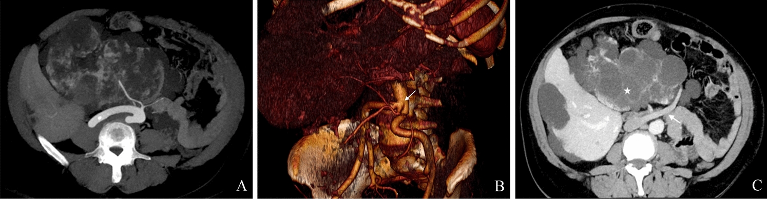 Polycystic pancake kidney