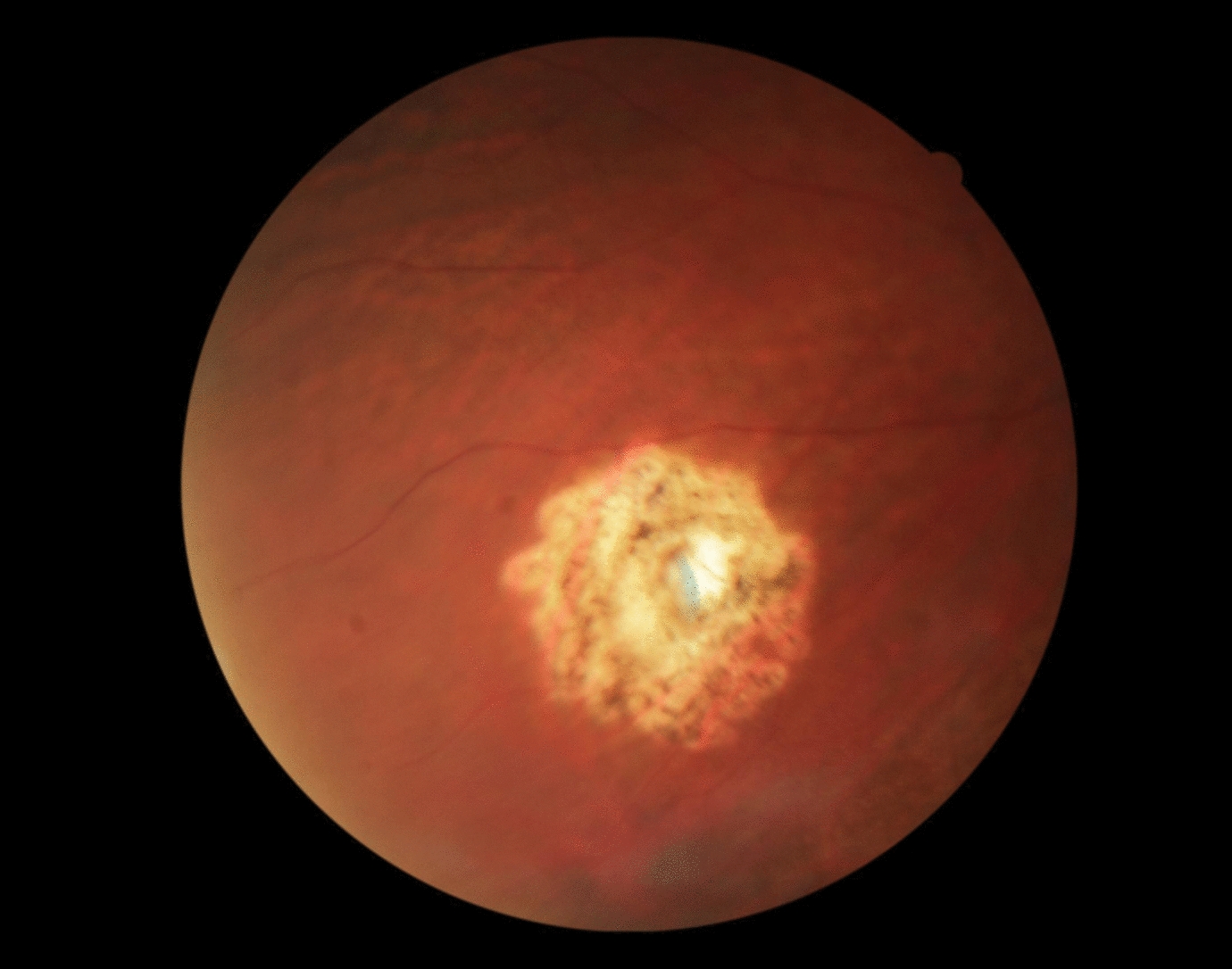 Scleral perforation during posterior scleral fixation: incidence and management strategies