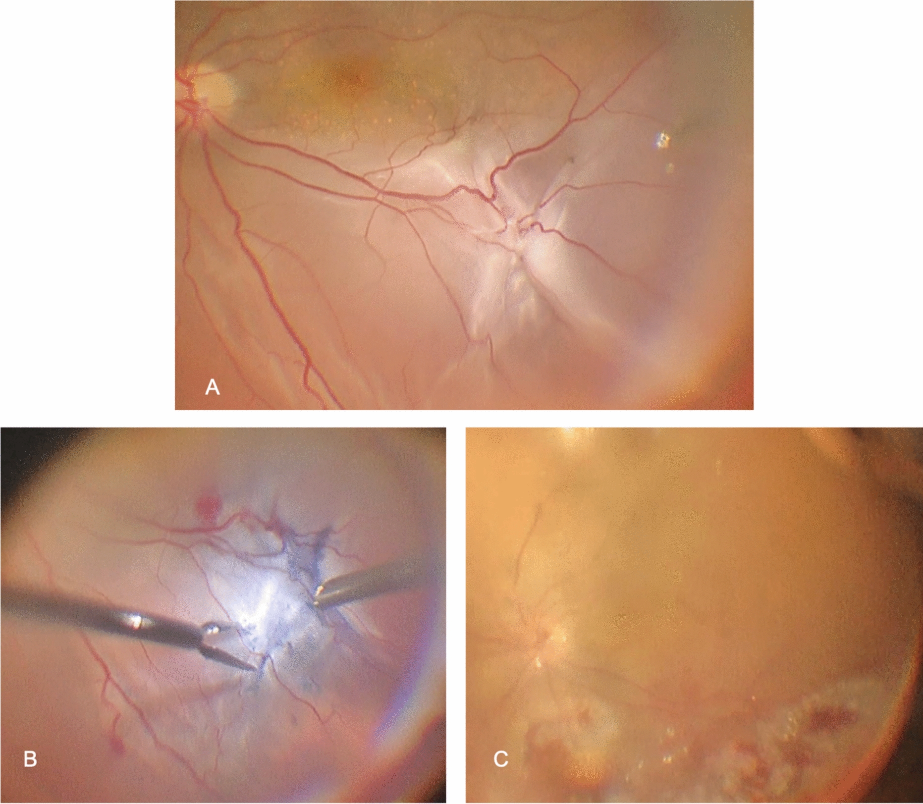 Comparison of gas and silicone oil tamponades for inferior quadrant recurrence in patients undergoing pars plana vitrectomy for rhegmatogenous retinal detachment