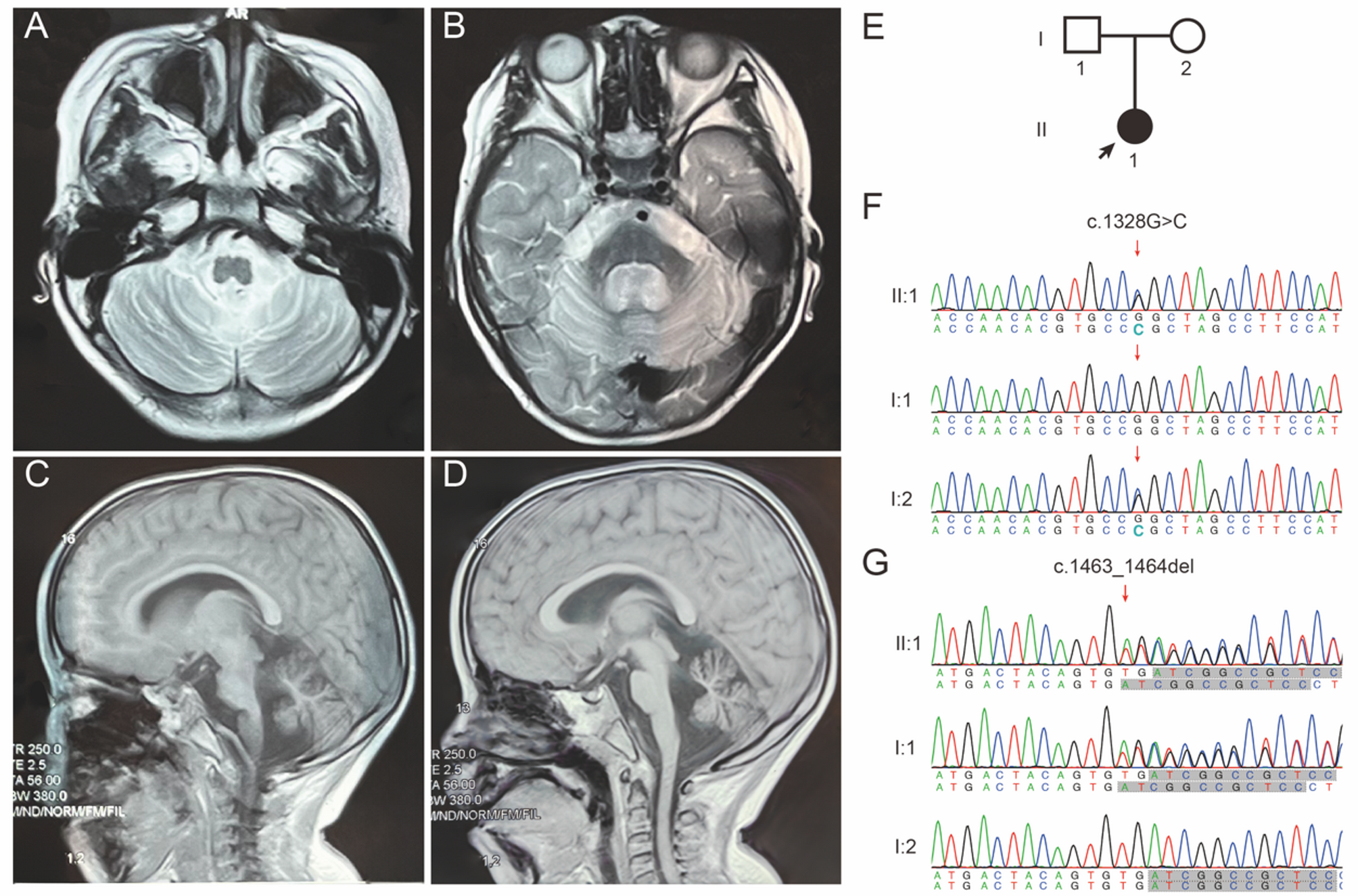 Identifying compound heterozygous variants in the EEFSEC gene linked to progressive cerebellar atrophy