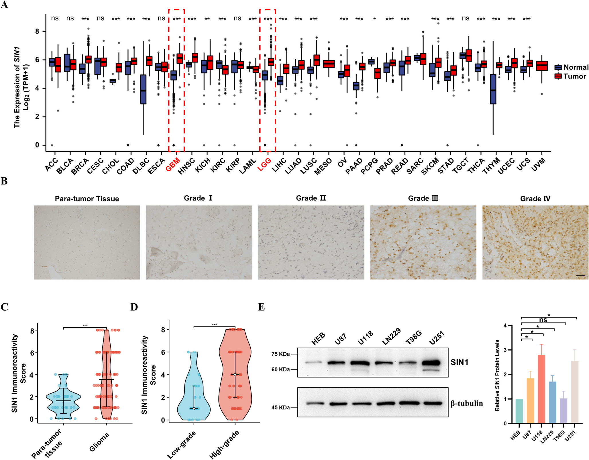 facilitates glioma progression and is associated with the KRAS/ERK pathway