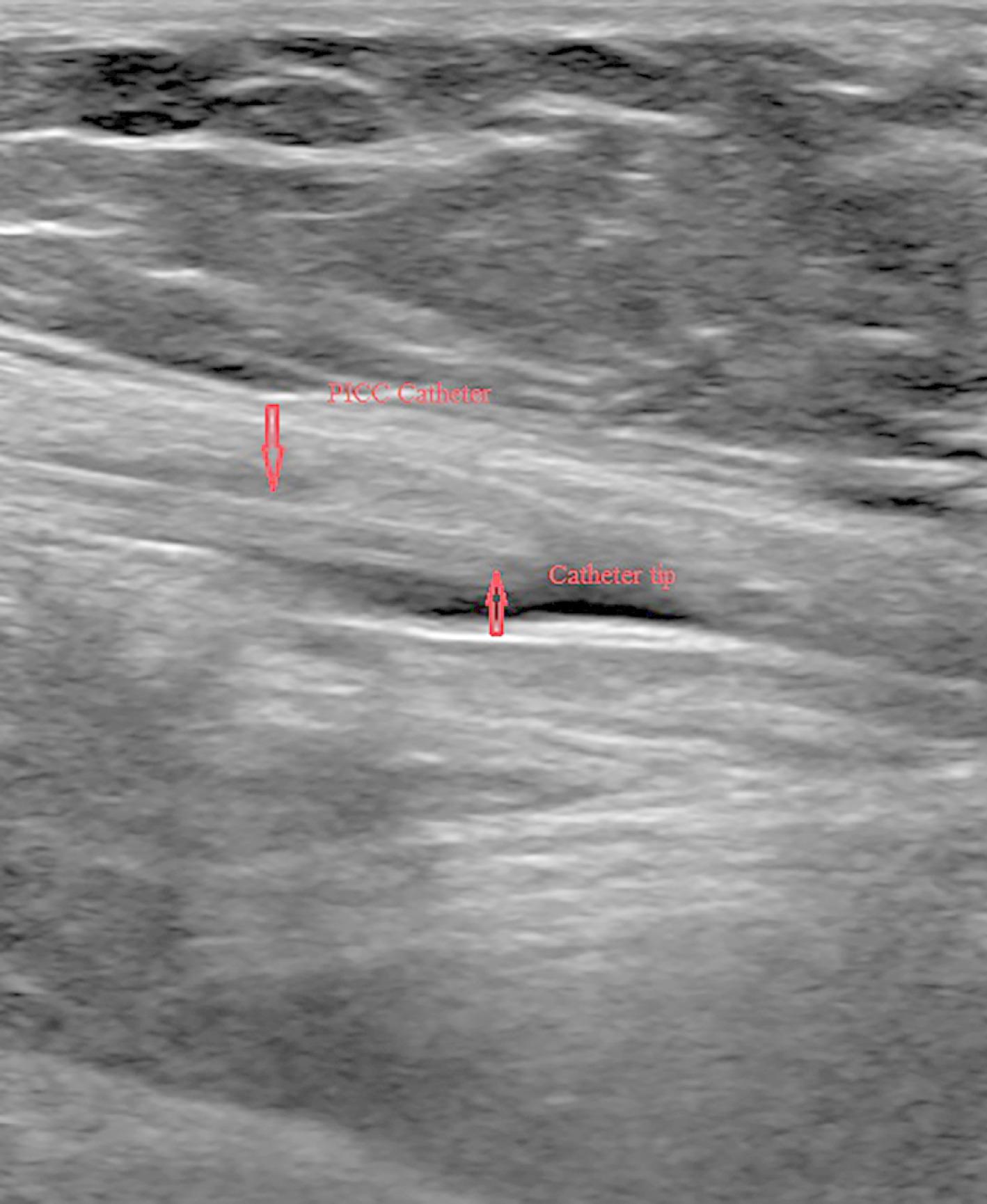 Analysis of 5 cases of PICC removal difficulty caused by fibroblastic sleeve