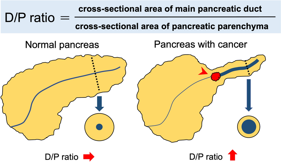 Deep learning-based automatic detection of pancreatic ductal adenocarcinoma ≤ 2 cm with high-resolution computed tomography: impact of the combination of tumor mass detection and indirect indicator evaluation