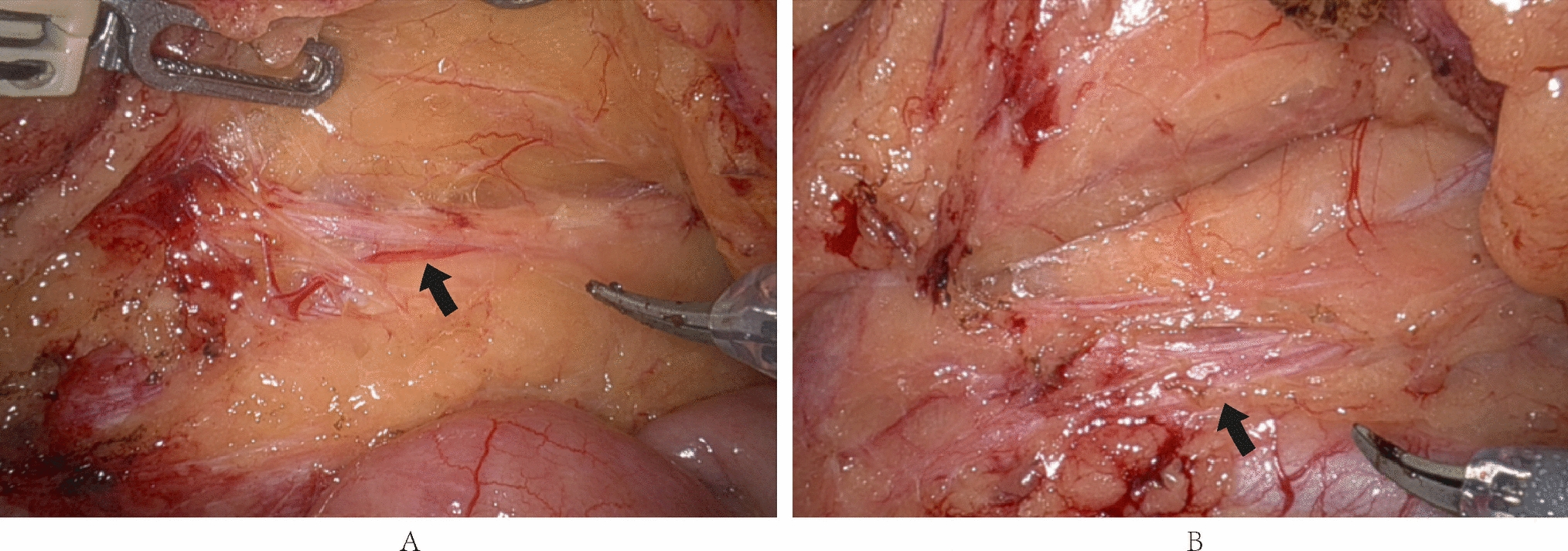 da Vinci robotic-assisted micro-space dissection and autonomic nerve network preservation technique in the total mesorectal excision procedure for rectal cancer: a single-center, retrospective, observational, real-world study