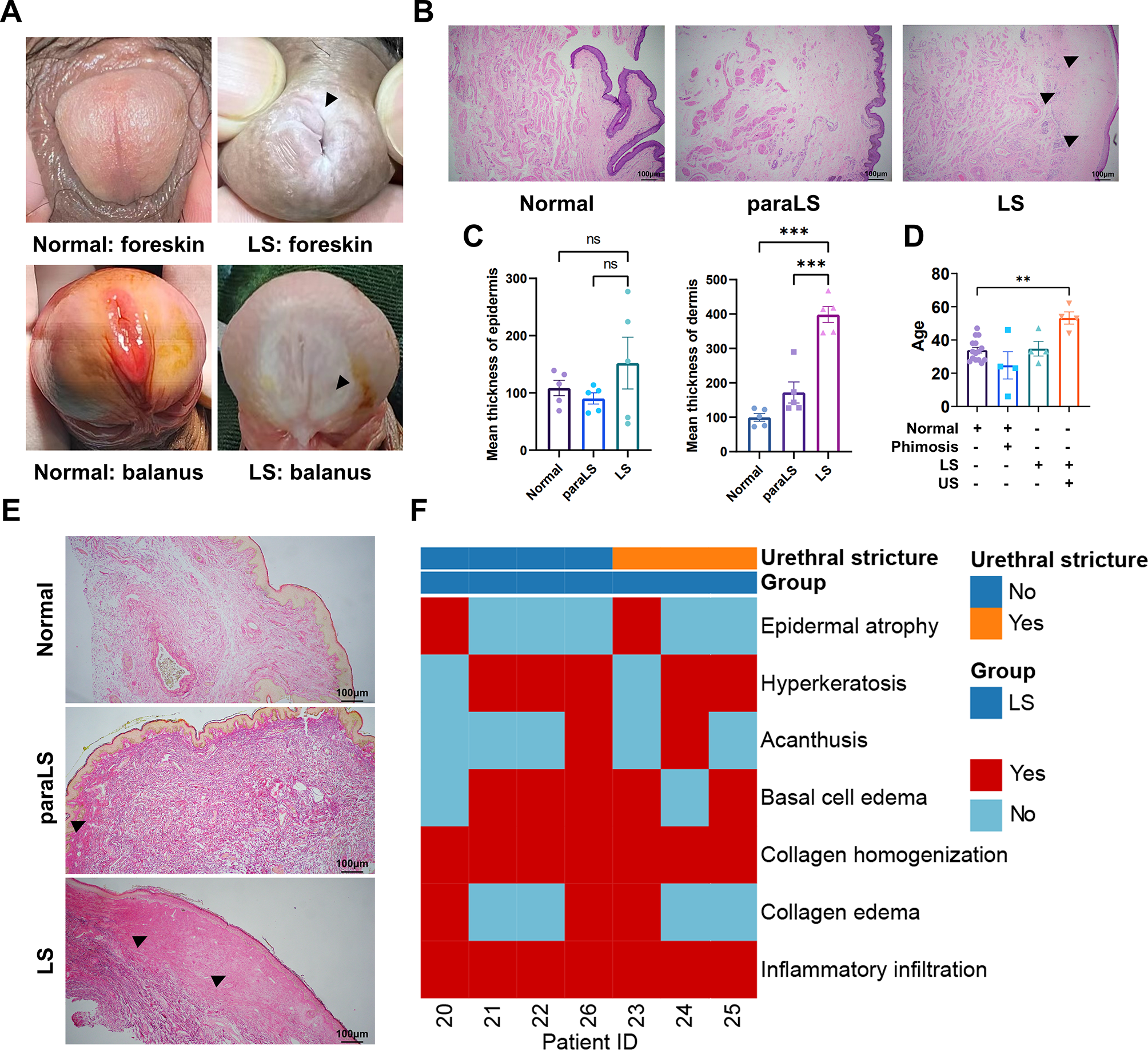 Multi-omics analysis unveiled fibroblast-mediated pathogenesis in male genital lichen sclerosus