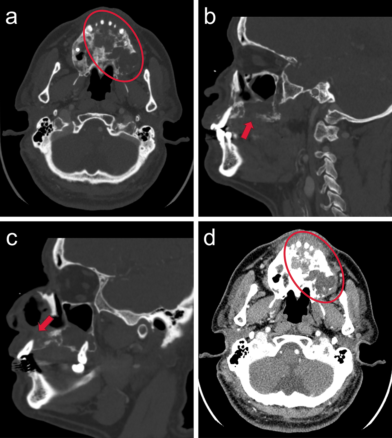 A Novel Odontogenic Carcinoma with CDK4/MDM2 Co-Amplification: Expanding the Phenotypic Spectrum of Malignant Odontogenic Entities