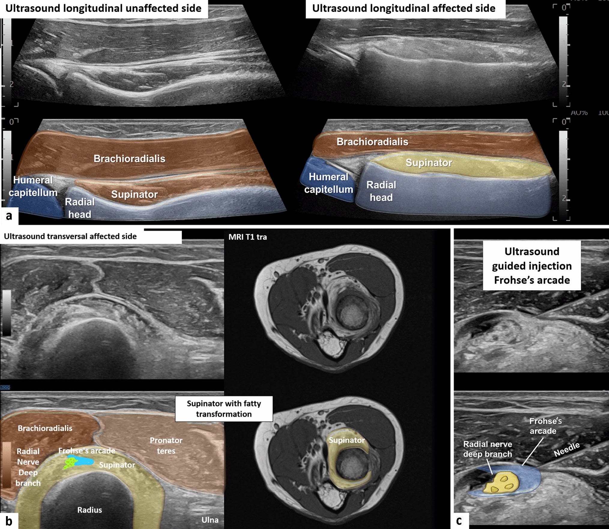 Ultrasound imaging-based diagnosis of deep branch radial nerve entrapment