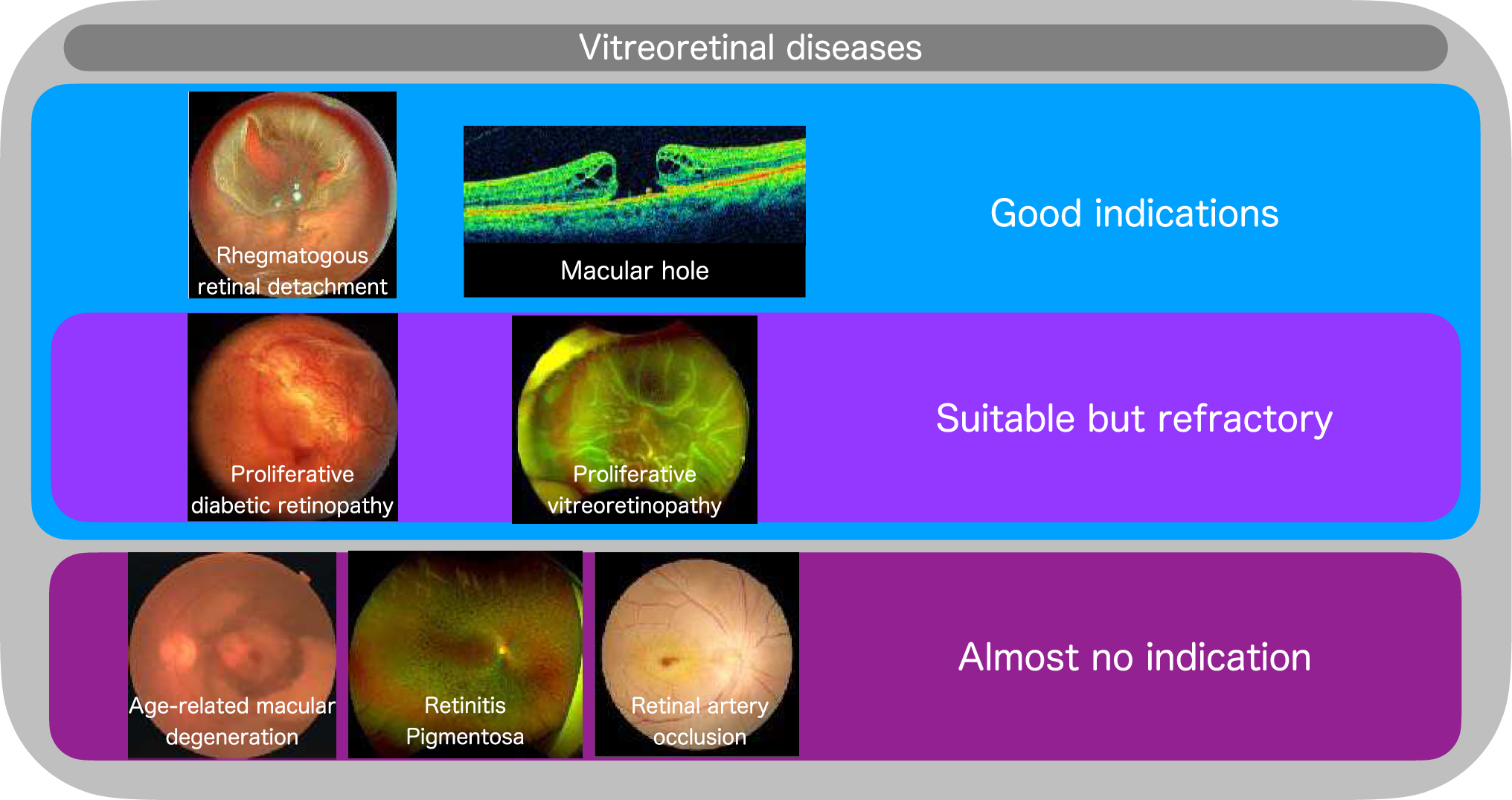 Advancements in robotic surgery for vitreoretinal diseases: current trends and the future