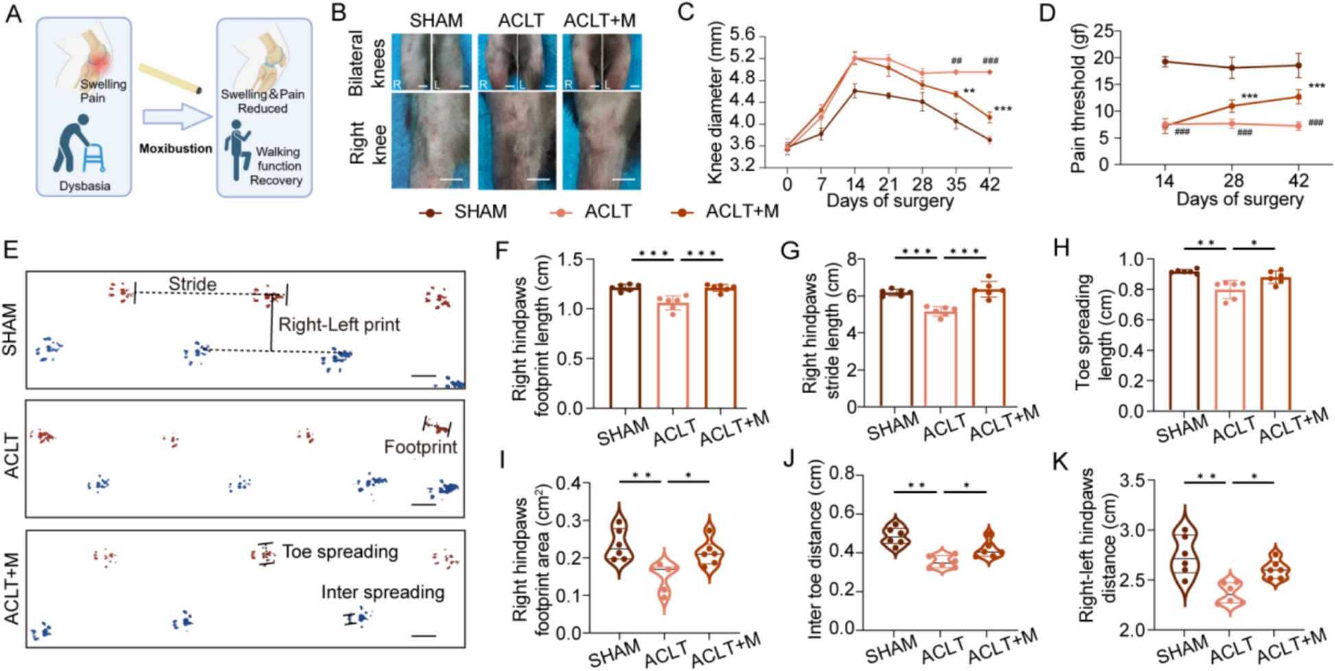 Moxibustion ameliorates abnormal subchondral bone remodeling by promoting ACSL1-mediated autophagy to degrade NLRP3 in osteoarthritis
