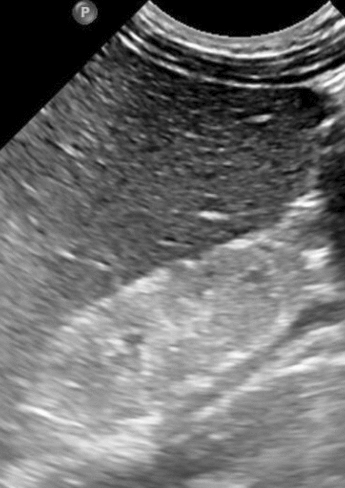 Williams syndrome presenting as infantile hypercalcemia with acute kidney injury: a case report