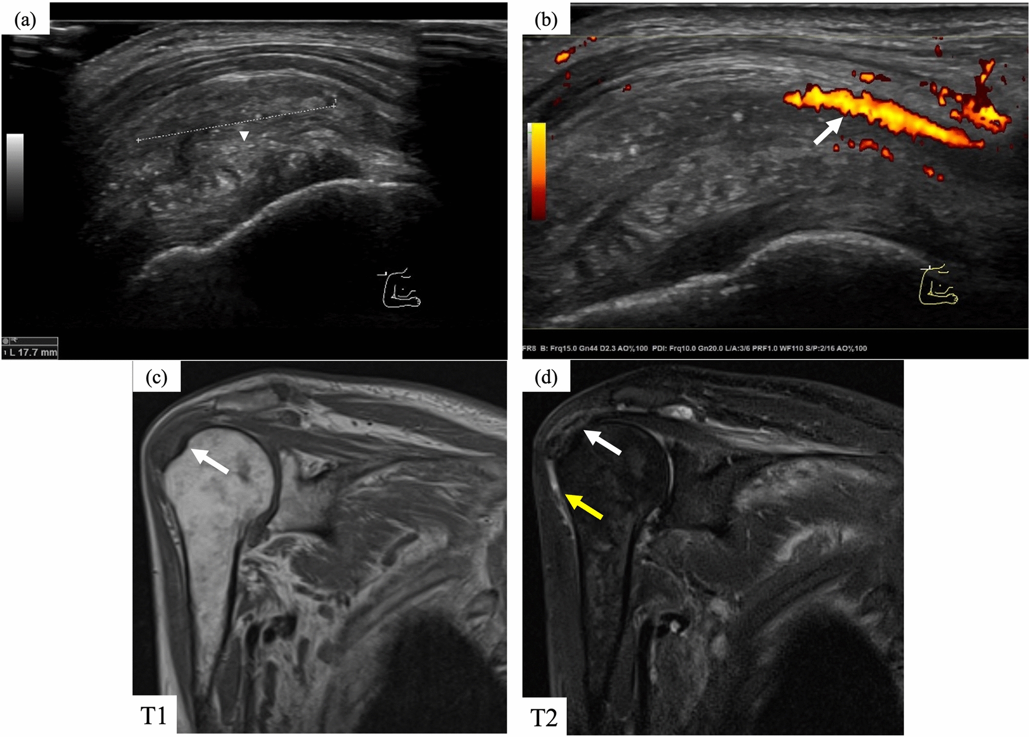 A case of effective tocilizumab for arthropathy due to dialysis-related amyloidosis