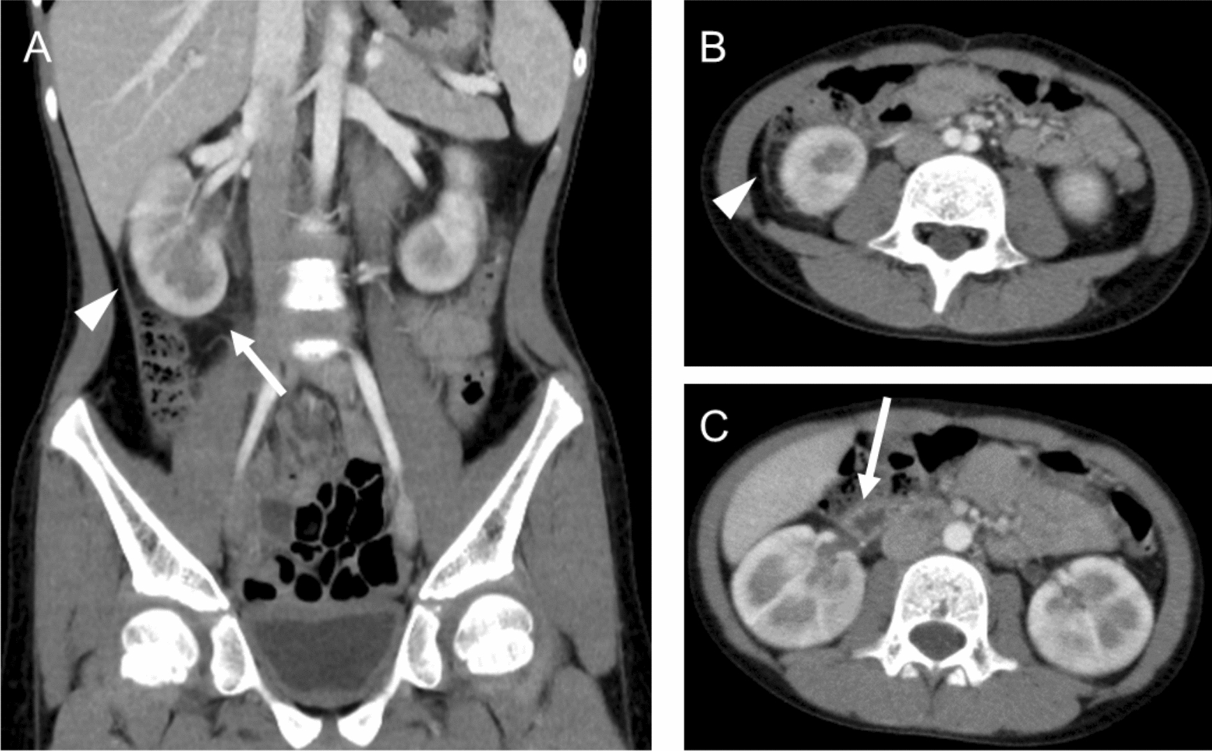 Renal and gastrointestinal complications following tosufloxacin therapy for suspected mycoplasma infection in a 10-year-old child