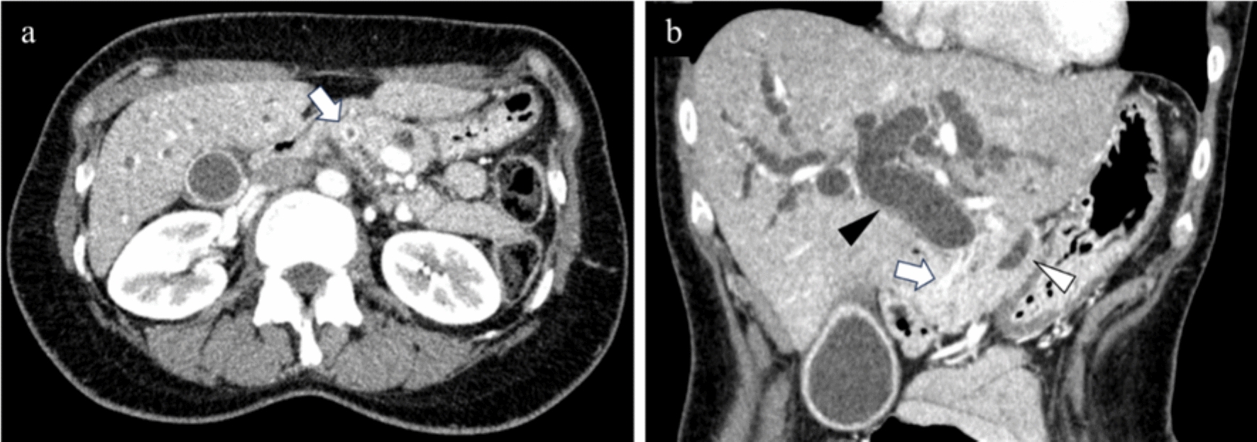 A case of  fusion-positive pancreatic head tumor with difficult differential diagnosis between cholangiocarcinoma and pancreatic ductal adenocarcinoma