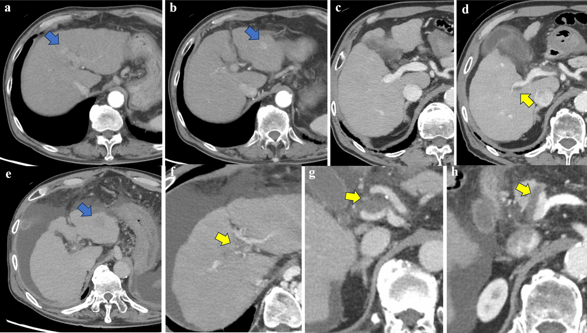 Fatal portal vein thrombosis following combination therapy with atezolizumab plus bevacizumab for hepatocellular carcinoma: an autopsy case report