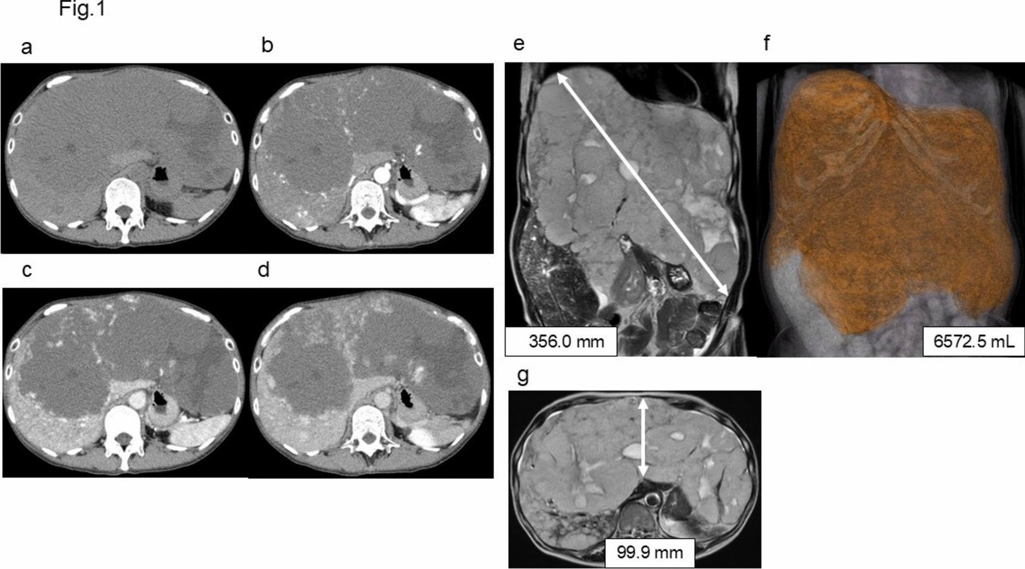 Giant hepatic hemangioma in a Japanese adult patient reduced by sirolimus therapy