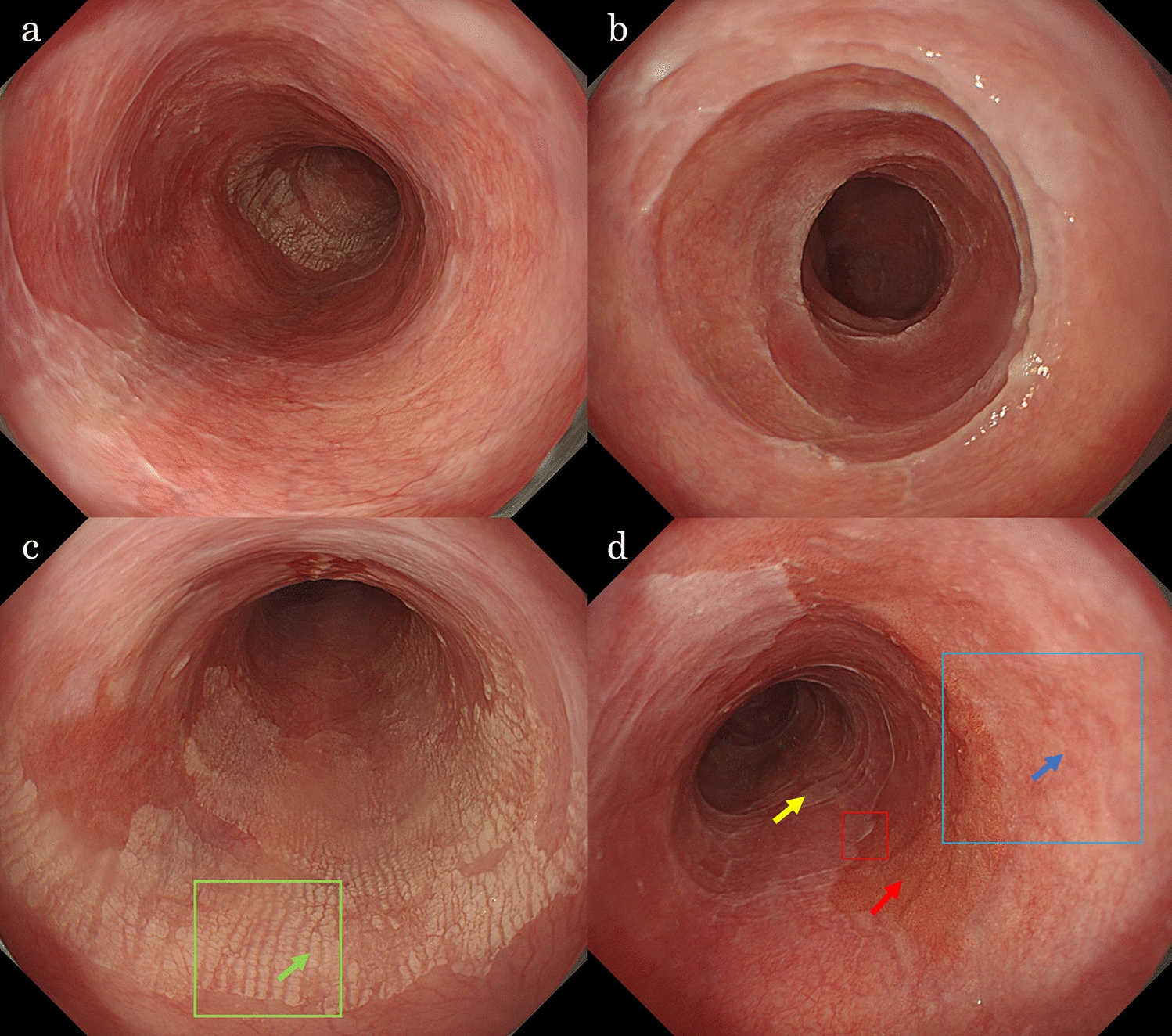 Superficial esophageal squamous cell carcinoma with esophageal lichen planus and esophageal epidermoid metaplasia treated with endoscopic submucosal dissection
