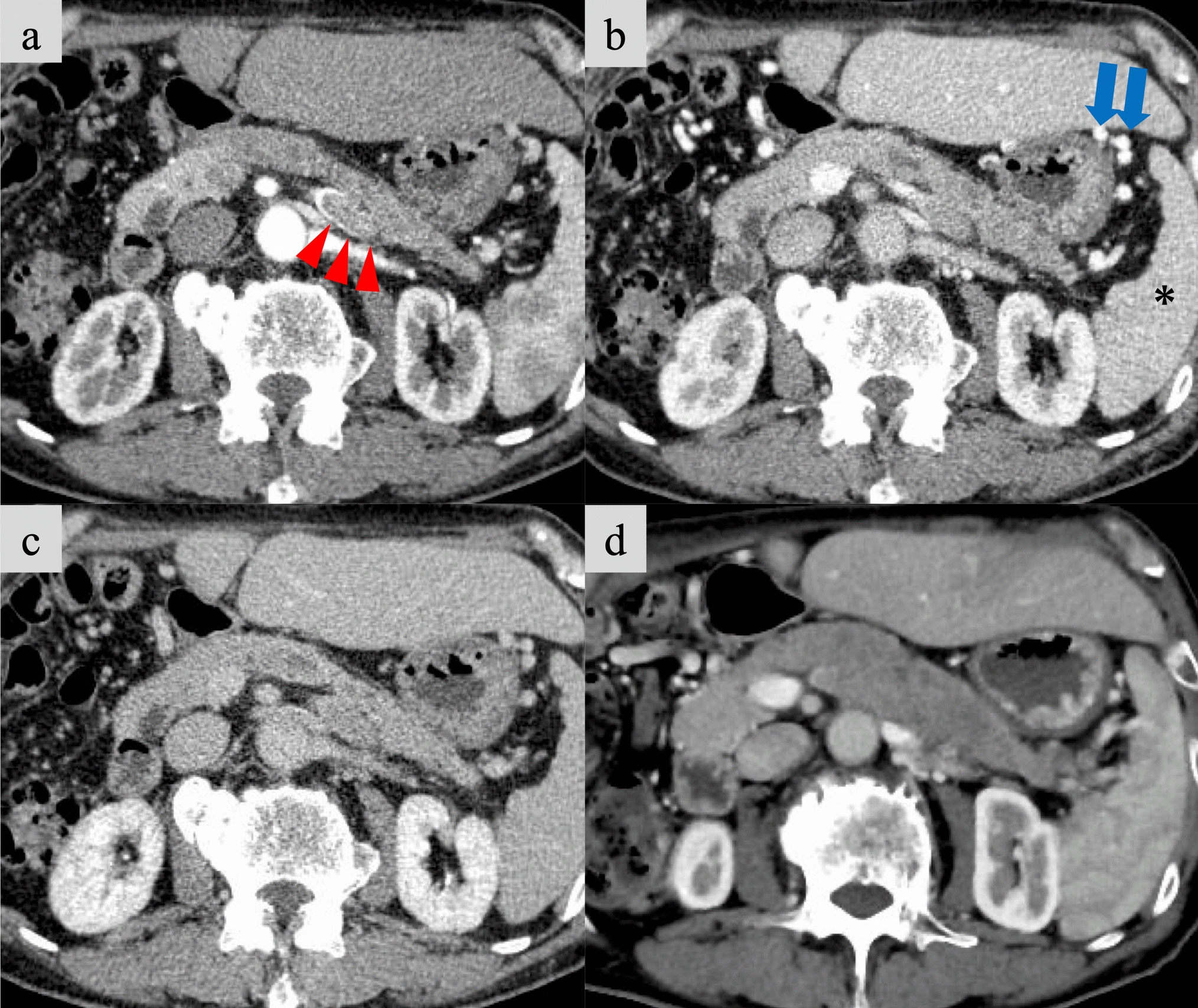 Hepatocellular carcinoma with recurrent pancreatic metastasis 17 years after radical resection